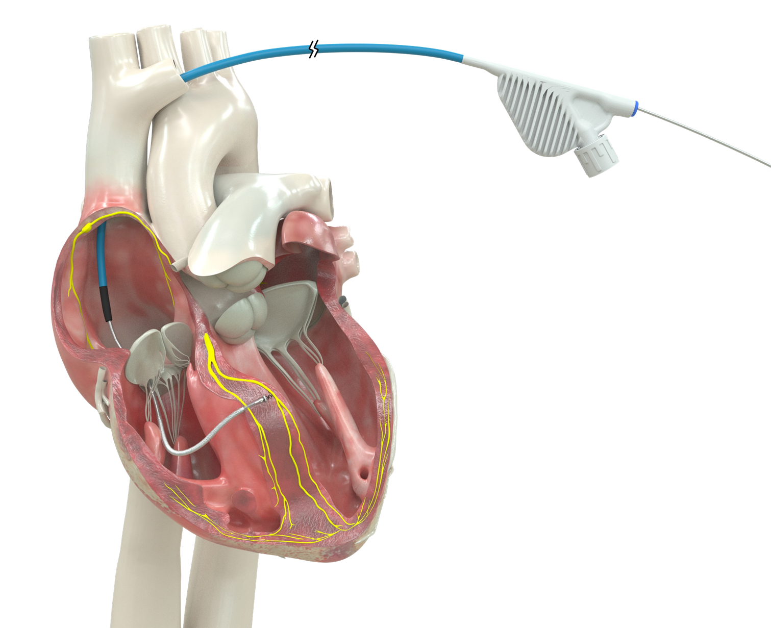 An illustration of a heart with ICD leads 