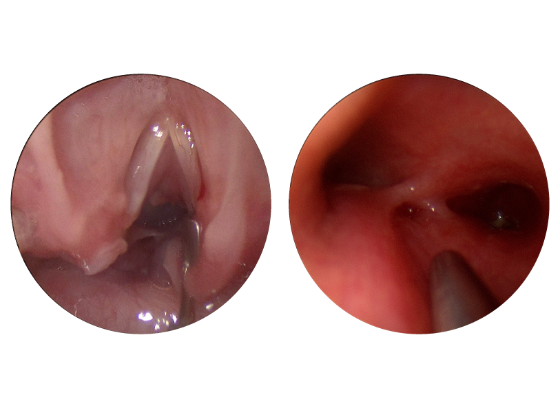 Images of type 3 laryngeal cleft