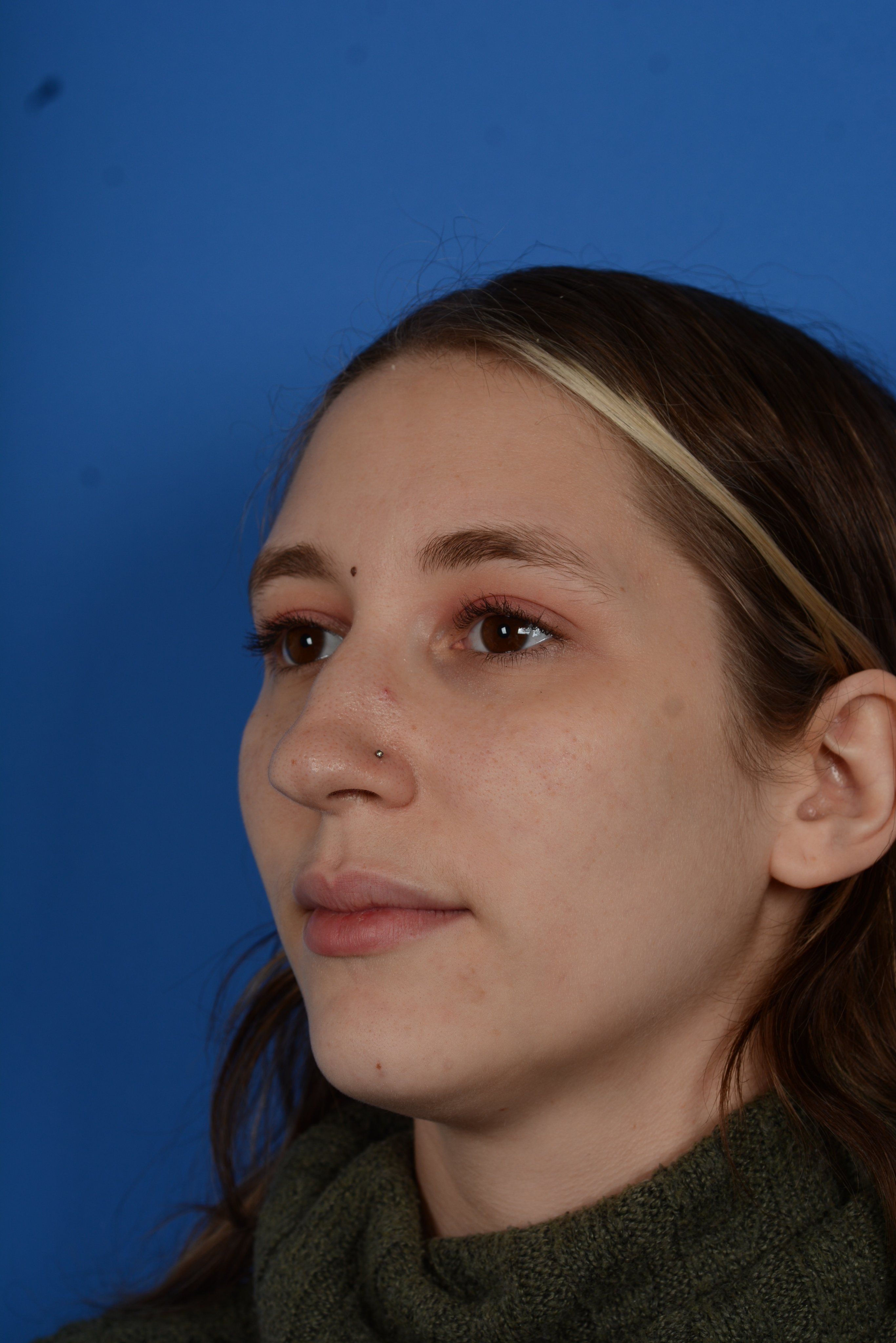 Patient before rhinoplasty, oblique left