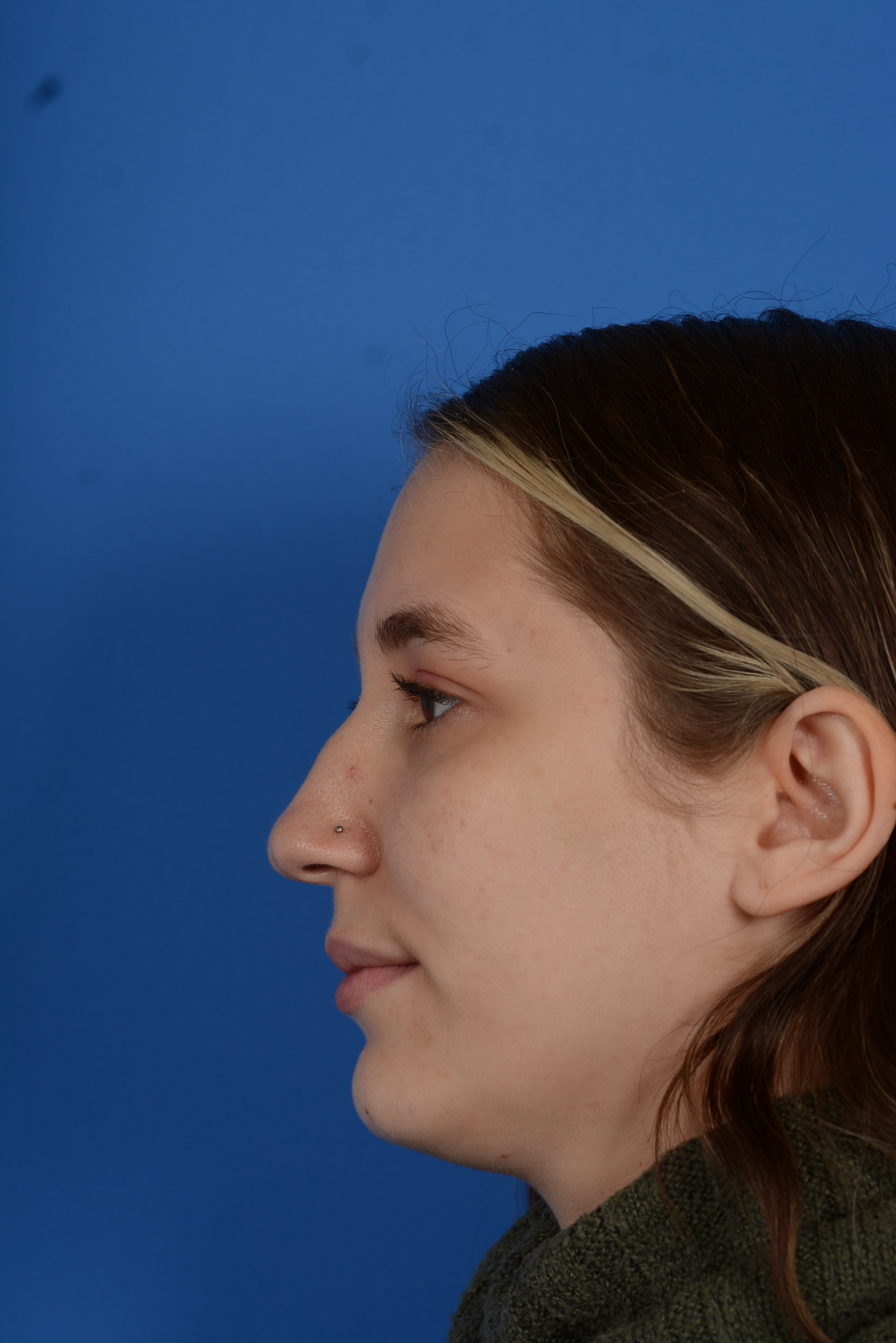 Patient before rhinoplasty, left side