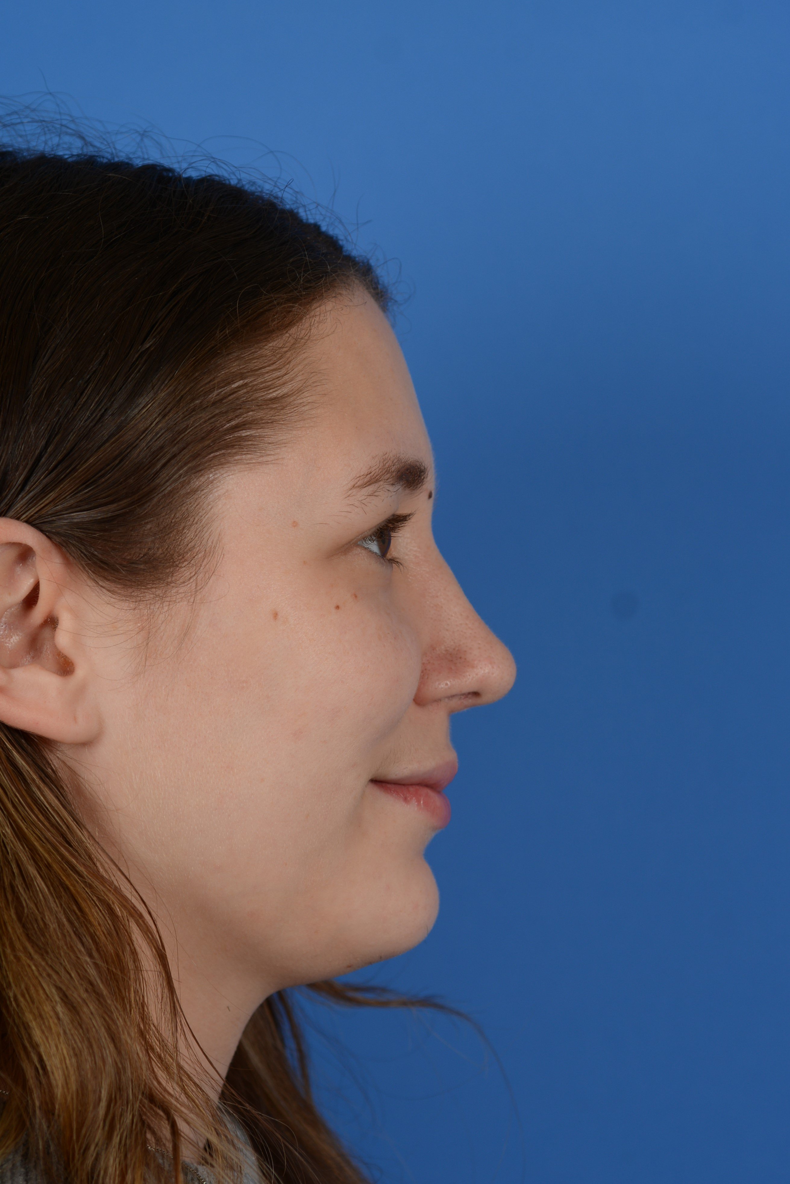 Patient after rhinoplasty, right side