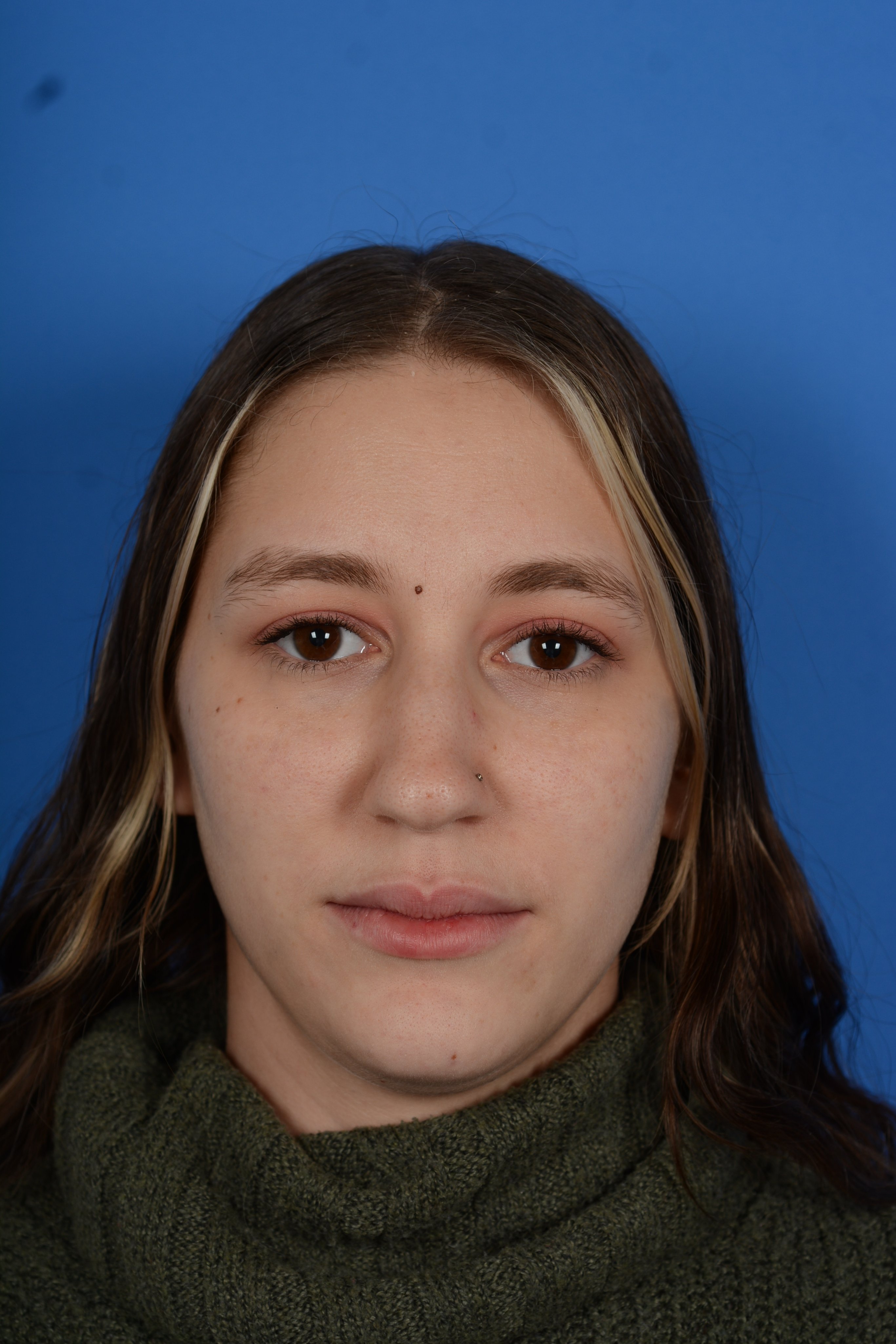 Patient before rhinoplasty, from front