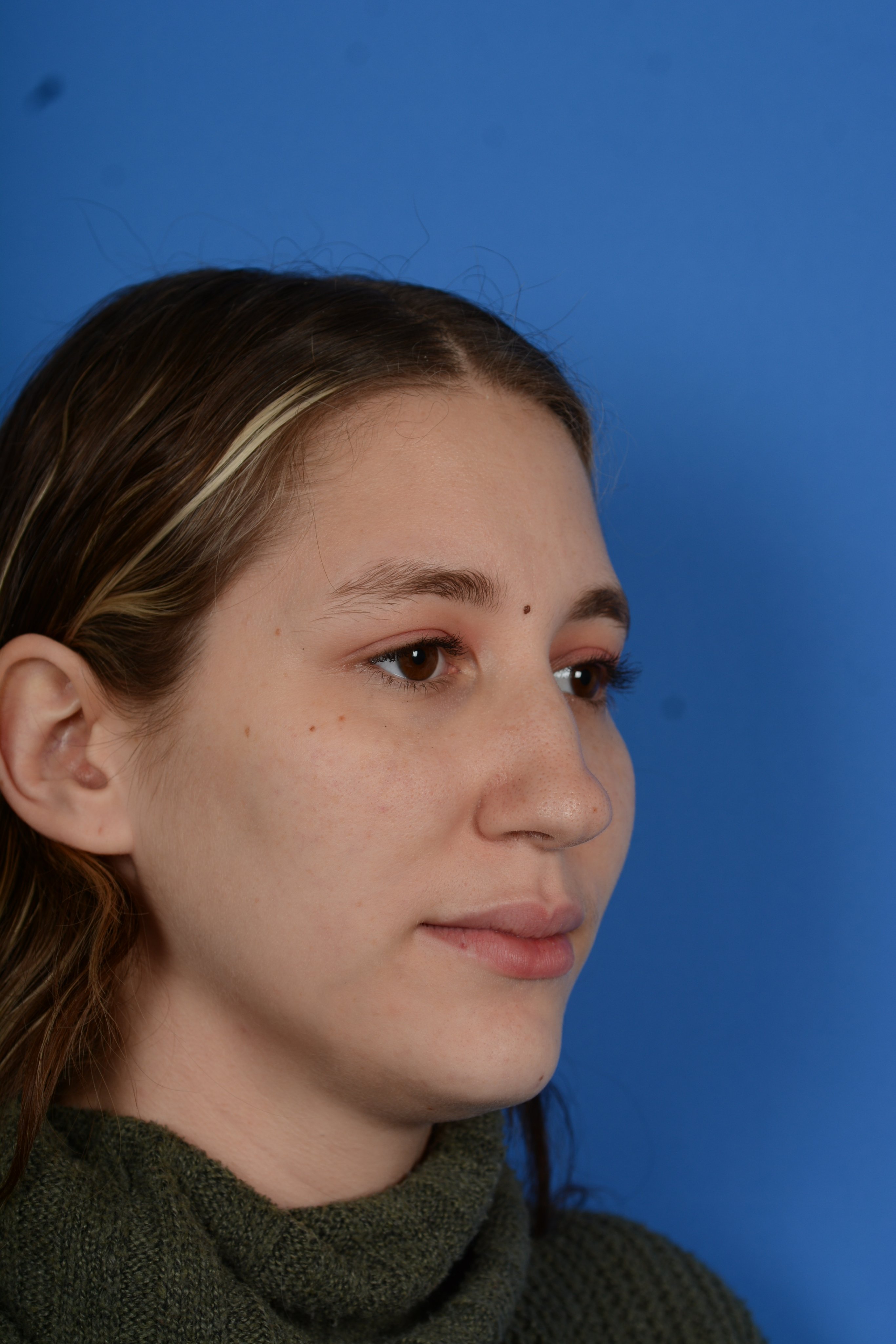 Patient before rhinoplasty, oblique right