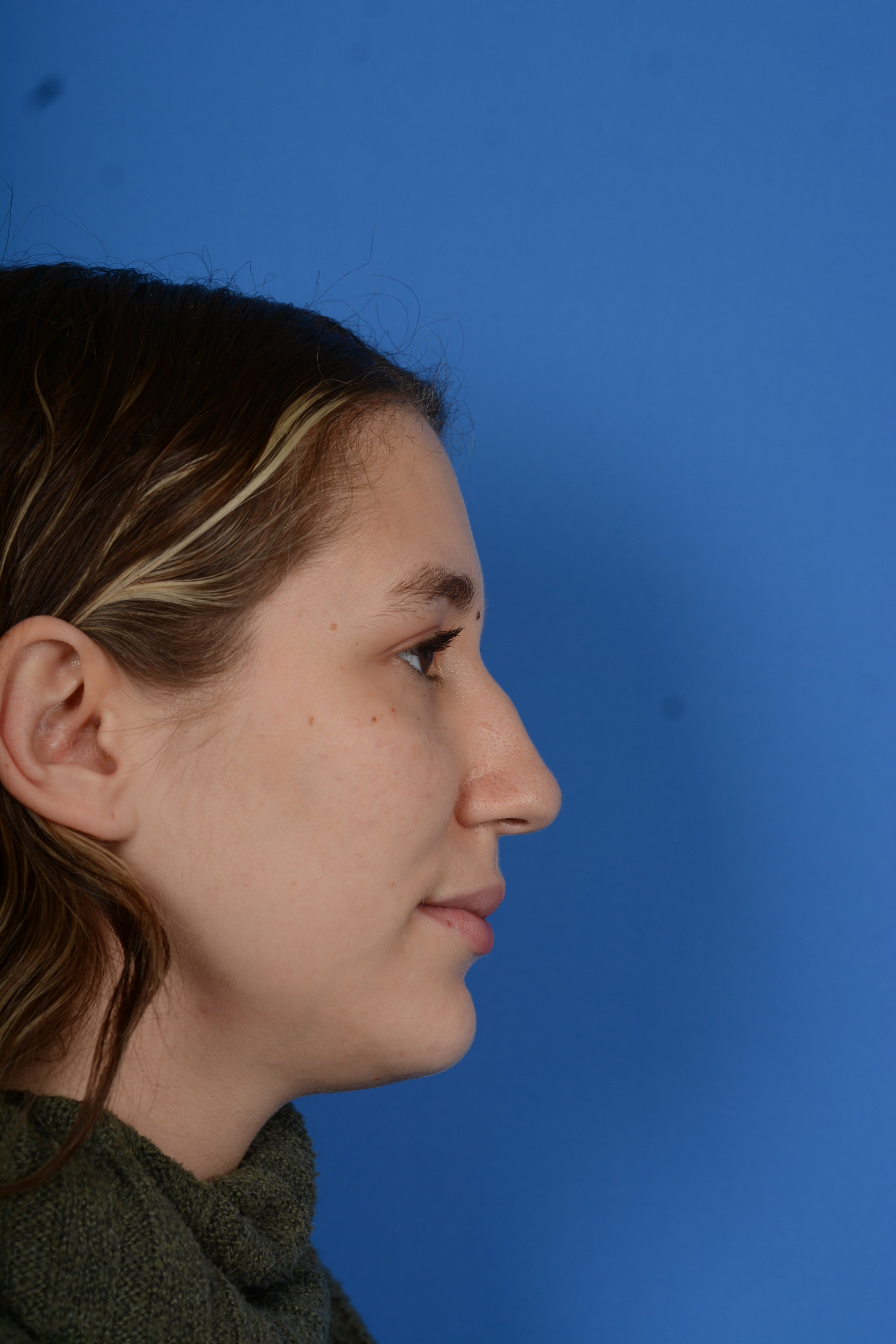 Patient before rhinoplasty, right side
