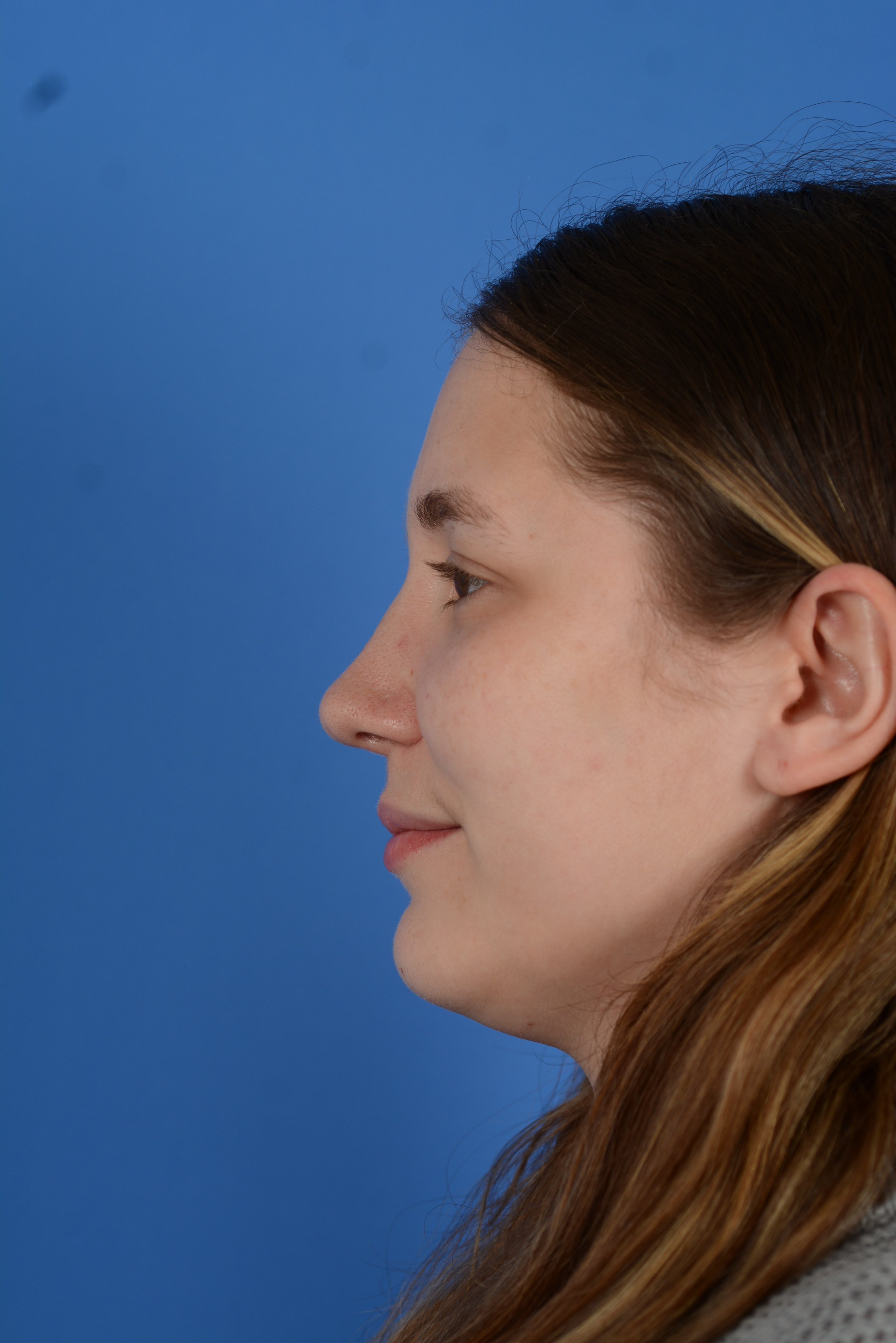 Patient after rhinoplasty, left side