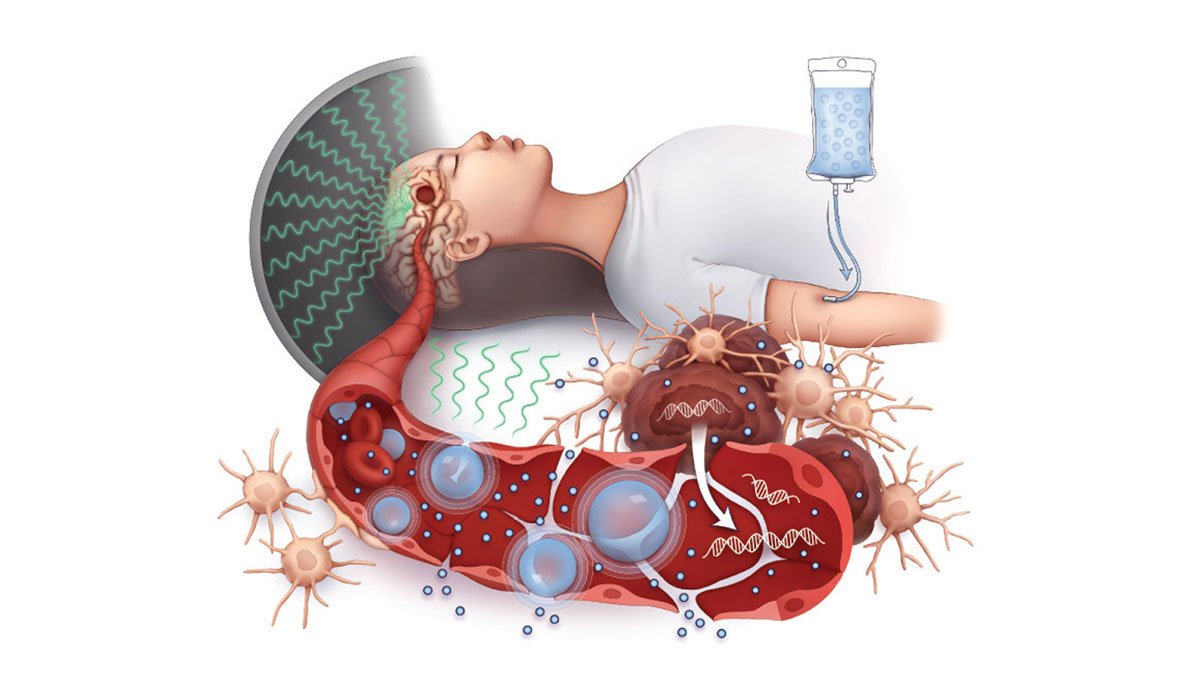 Illustration showing the use of microbubble-enhanced transcranial focused ultrasound to open the blood brain barrier and enhance drug delivery
