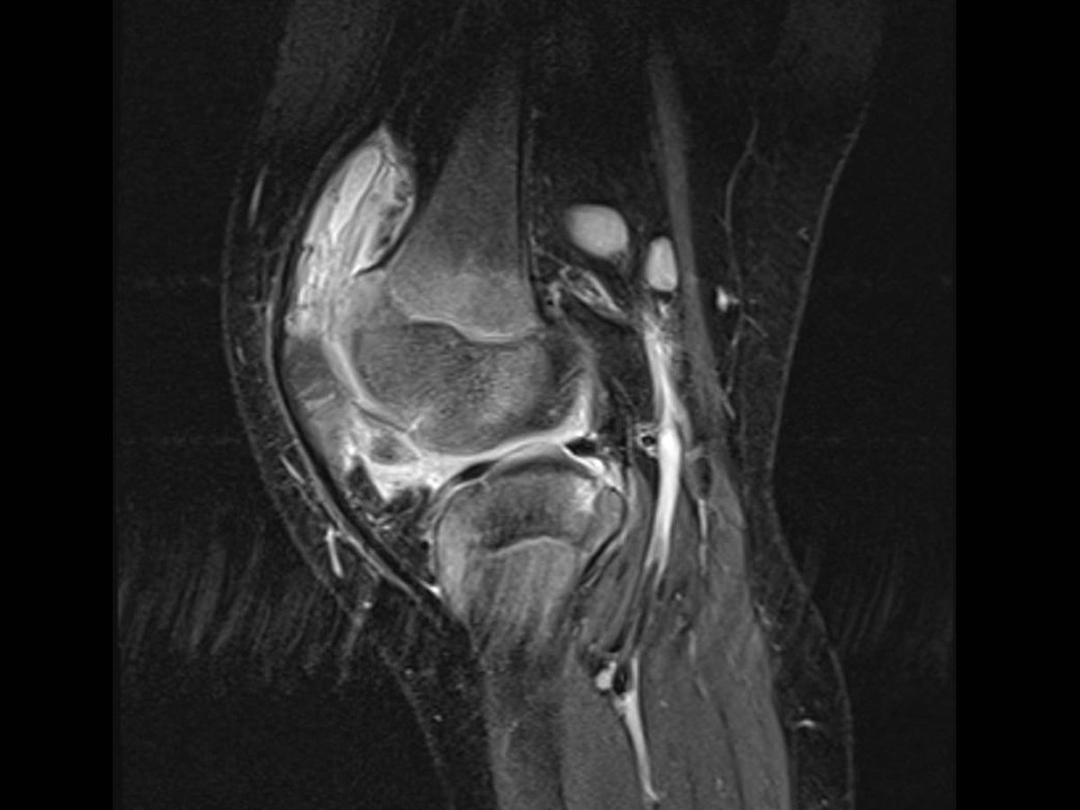 MRI shows TB inside young child's knee