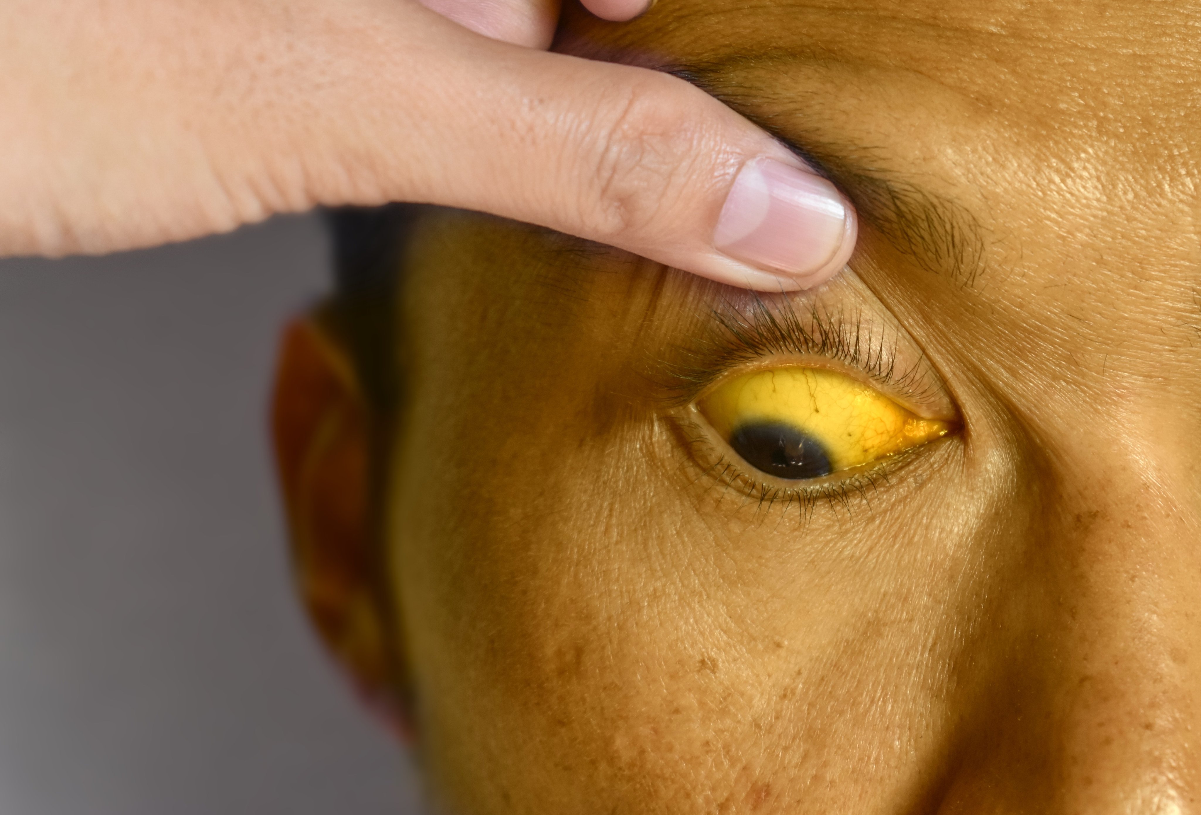 Man with jaundice