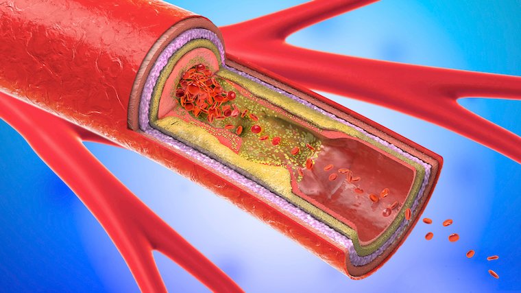A clogged artery that can lead to stroke