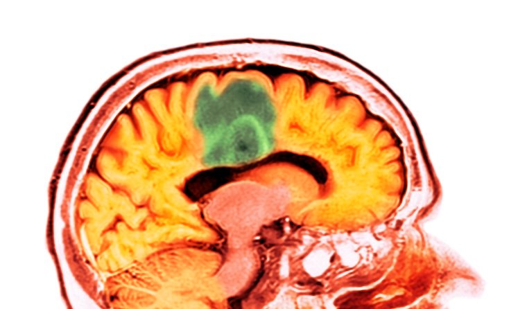 Colorized brain scan