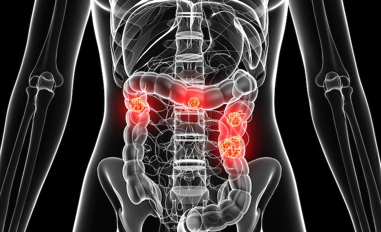 Artist's rendering depicting a cancerous colon