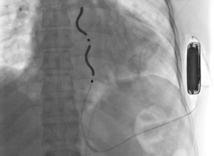 An implantable cardioverter defibrillator seen in this imaging scan
