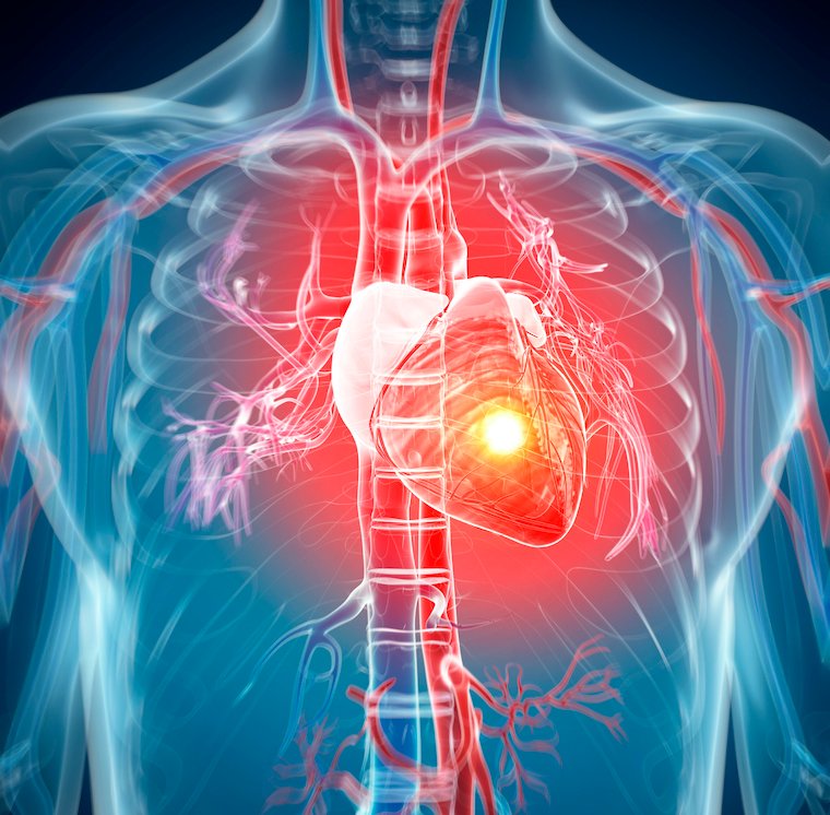 Illustration shows heart attack