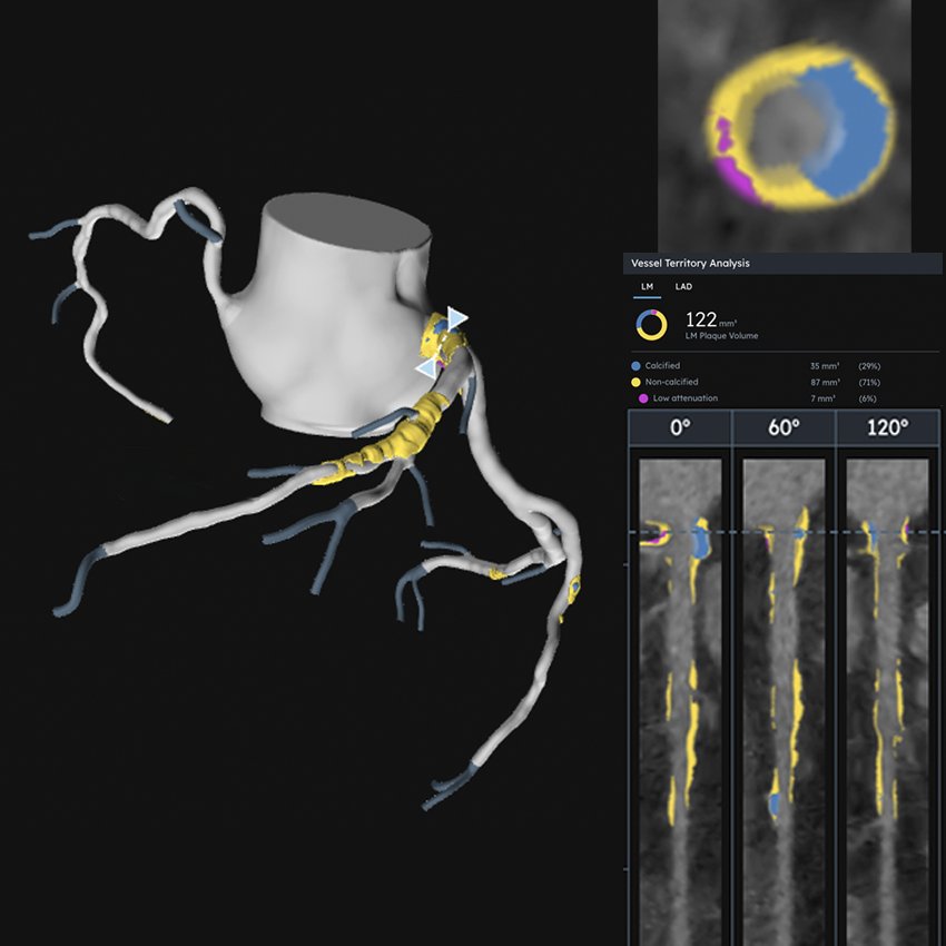 AI evaluation of coronary CT angiography (CCTA) images uncovers critical details about arterial plaque composition not detected by other means.