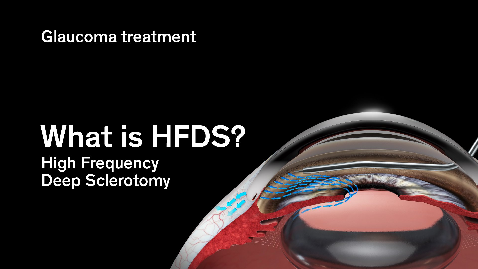Illustration explaining HFDS, high frequency deep sclerectomy, in glaucoma treatment showing aqueous humour outflow pathway