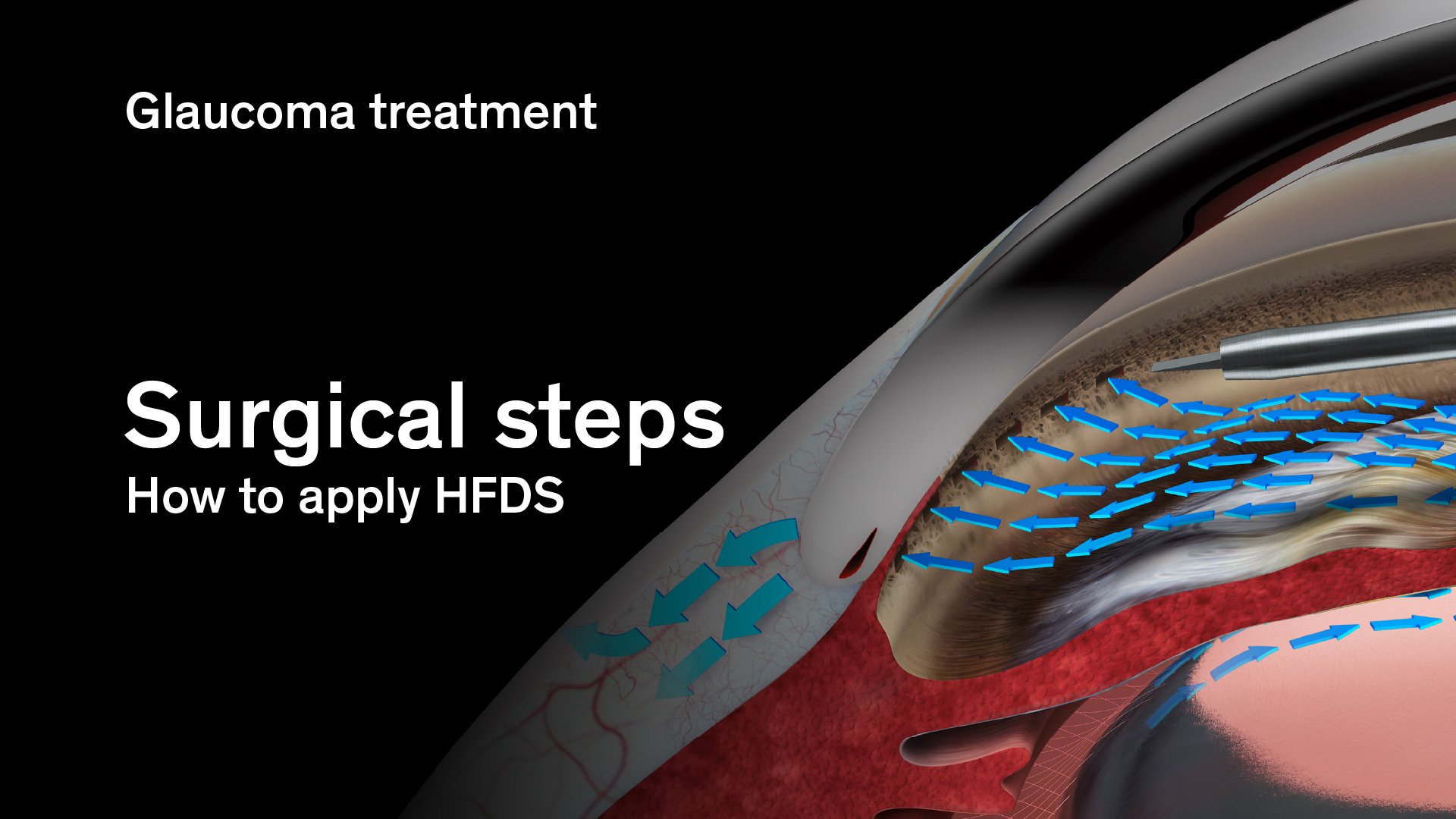 Illustration of HFDS glaucoma treatment showing surgical steps and aqueous humour outflow pathways