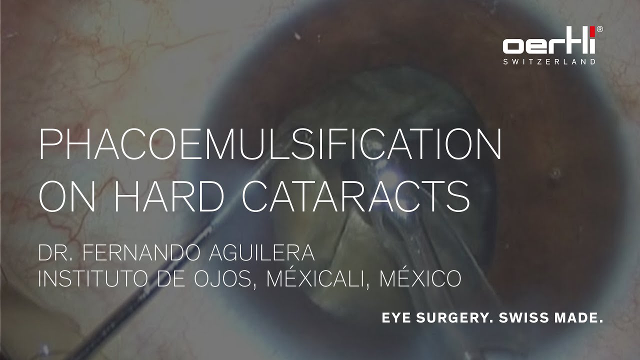 Phacoemulsification on hard cataracts performed by Dr Fernando Aguilera, Instituto de Ojos Mexicali, with surgical close up