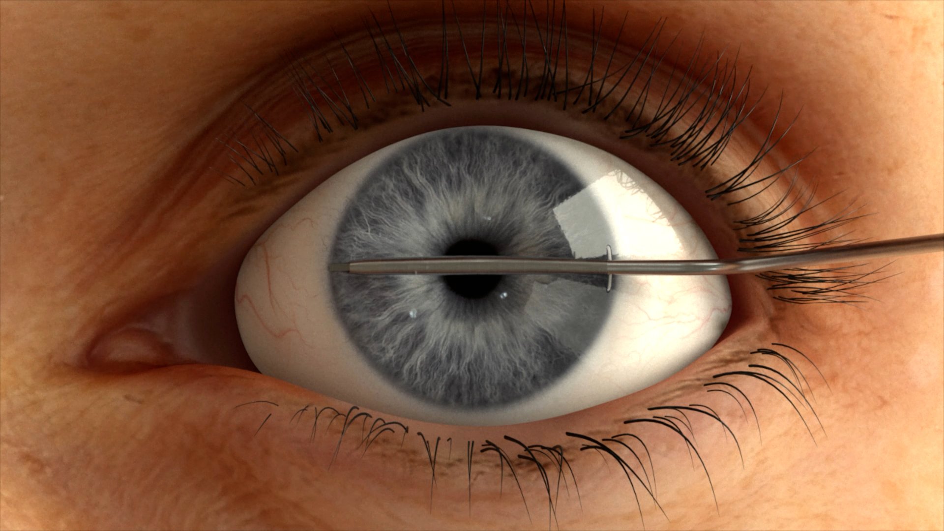 Close-up of a human eye during ophthalmic surgery, showing a surgical instrument inserted through the cornea towards the pupil