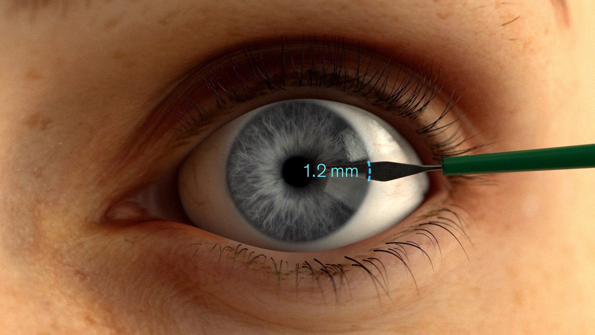 human eye with hfds incision