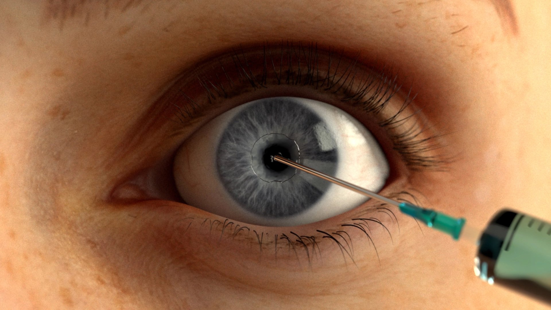 human eye with instument in action