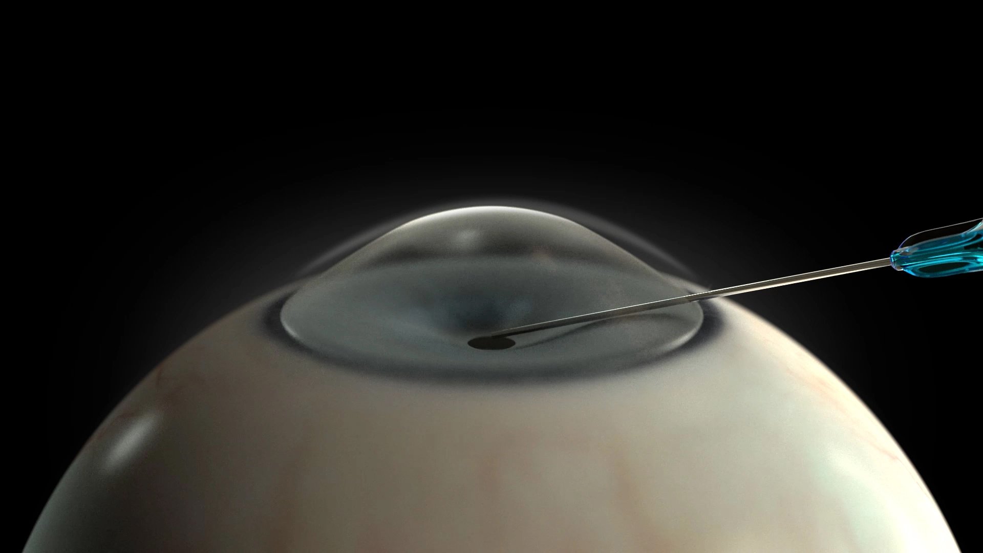 human eye visualisation with hfds incision
