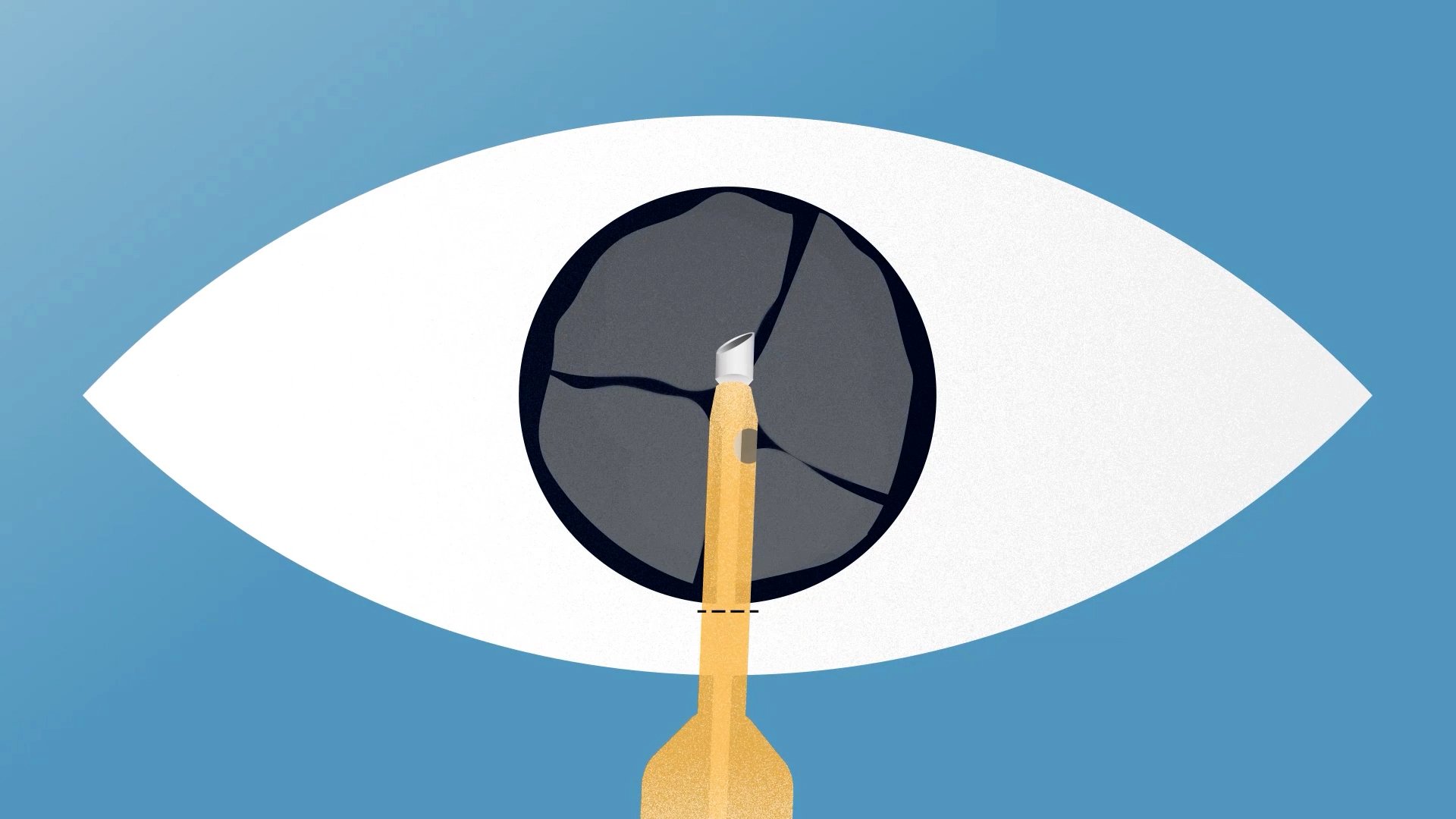 Phaco tip centred in capsulotomy for stable lens fragmentation