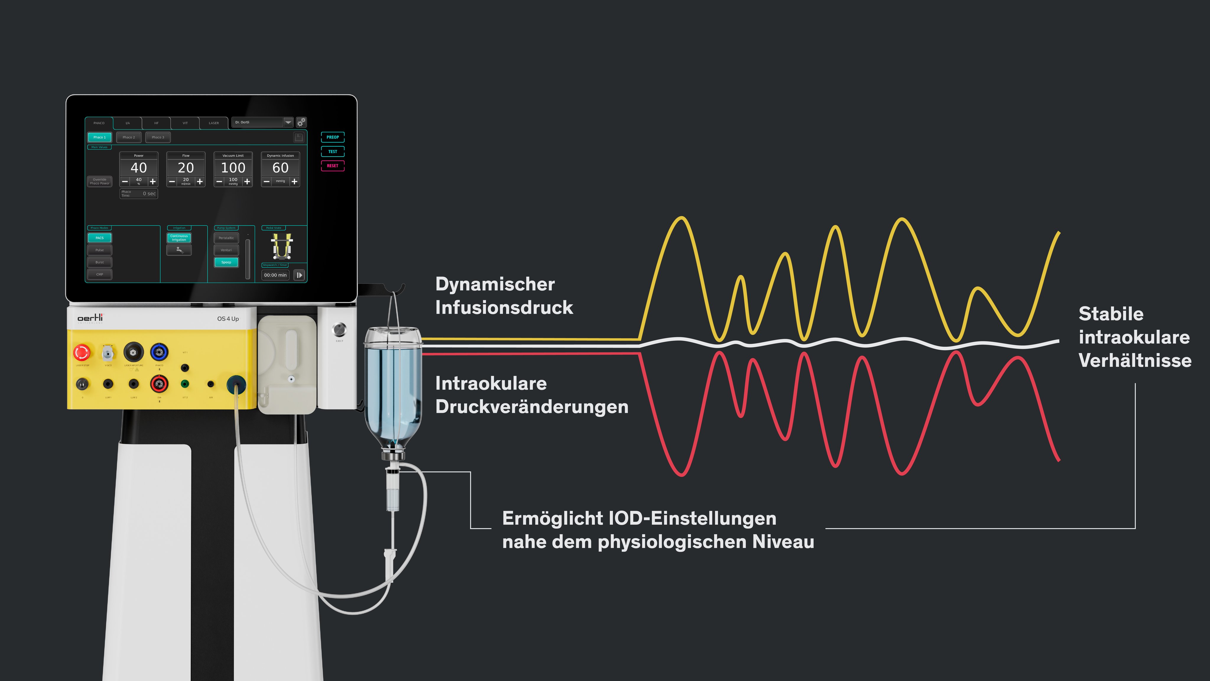 Graphic visualising Dynamic Infusion technology with stable intraocular pressure conditions during eye surgery