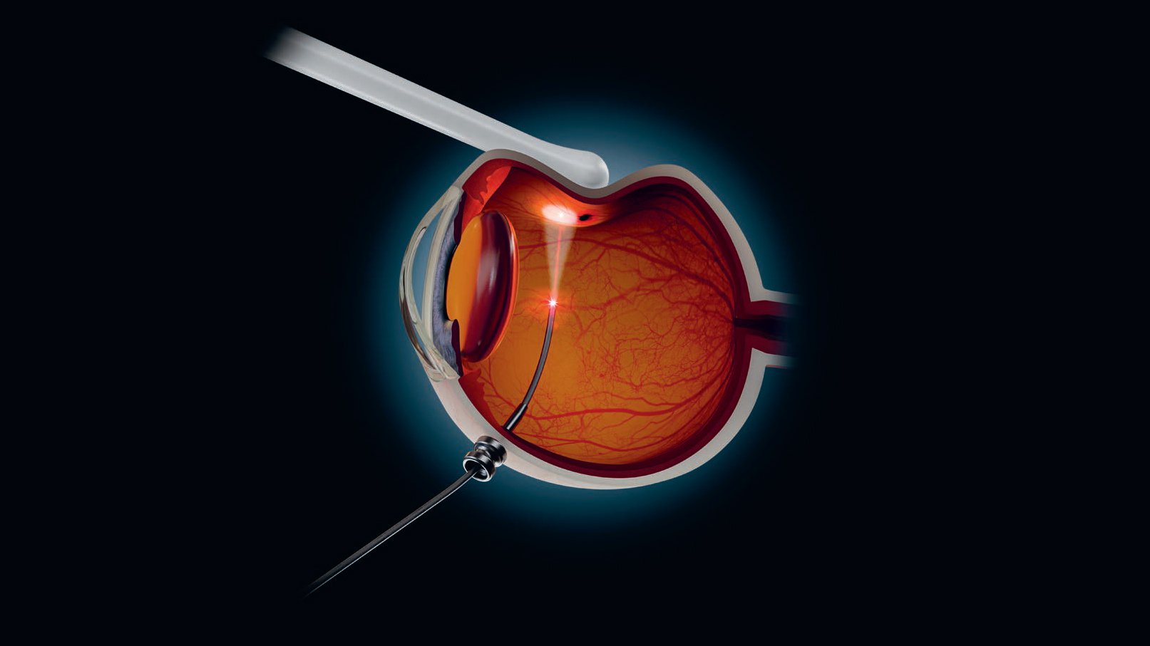Ophthalmic laser probe applying laser energy inside a cross sectional eye illustration