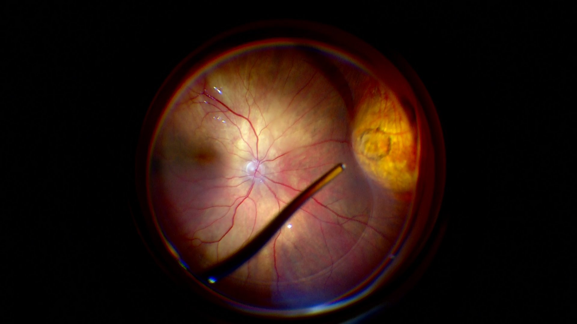 Intraoperative retinal view during vitreoretinal surgery with illuminated optic disc and surgical instrument