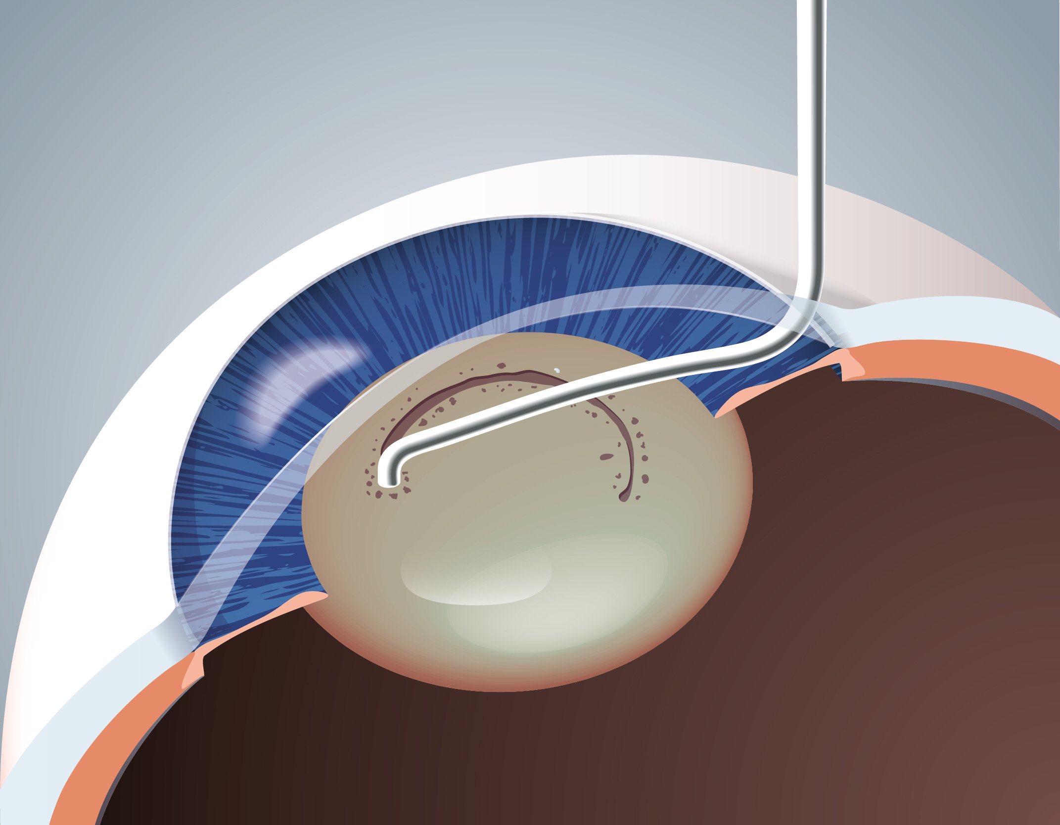 Ophthalmic surgical illustration of a capsulotomy instrument in the eye