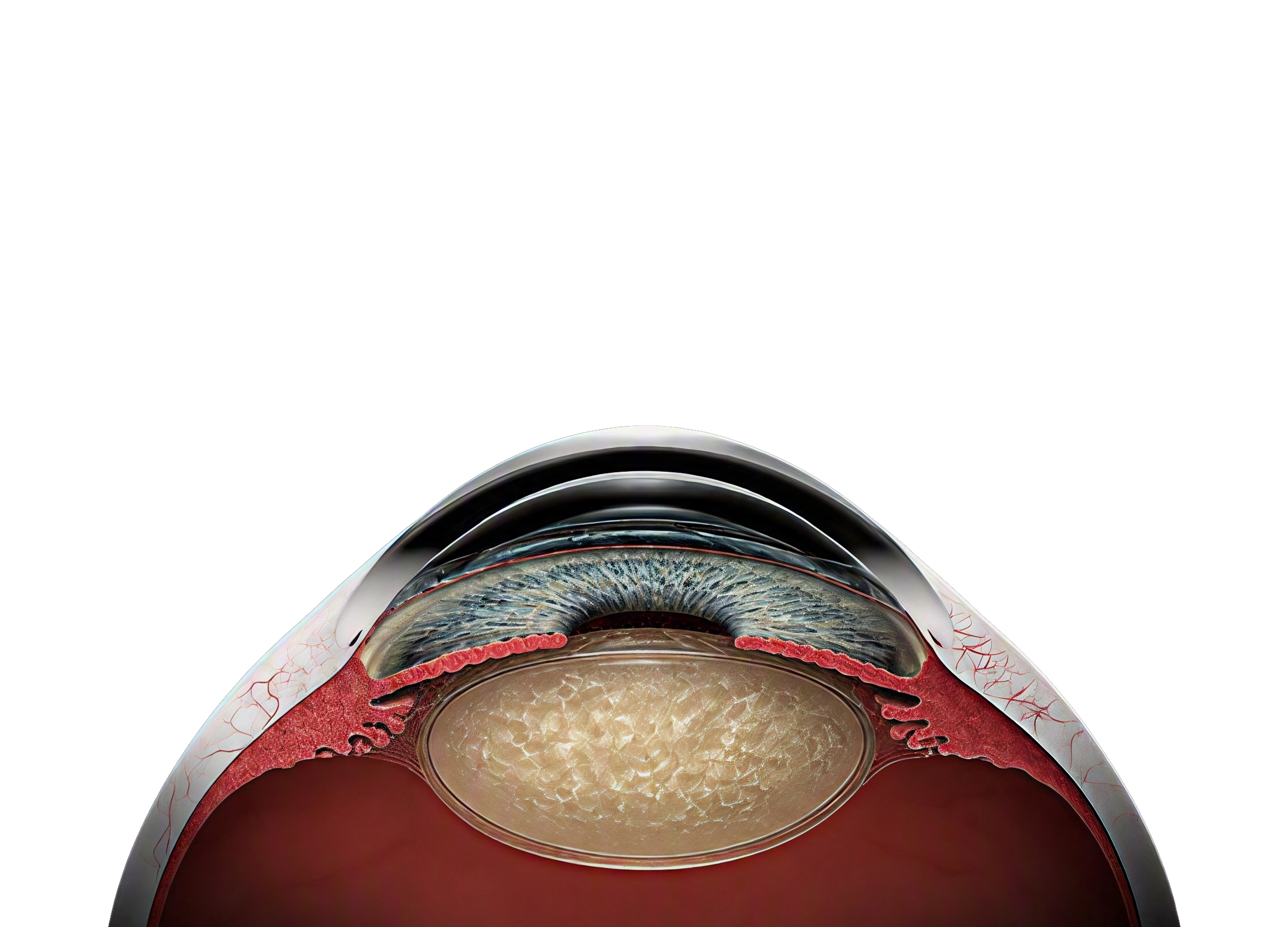 Medical illustration of a cataract within the human eye showing lens opacity and ocular anatomy