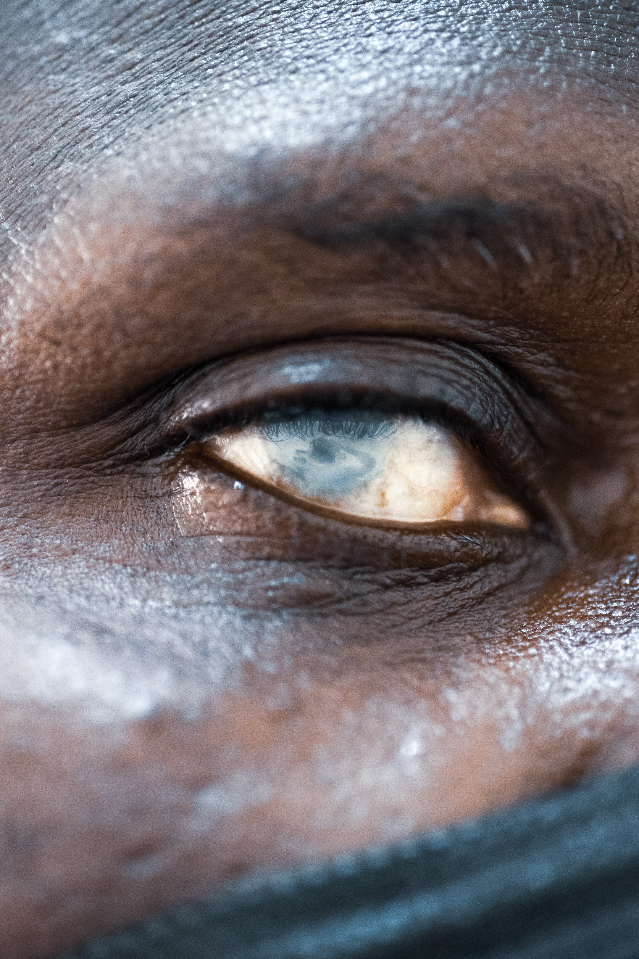 Macro close up of a human eye with a visible mature cataract causing clouding of the lens and impaired vision.