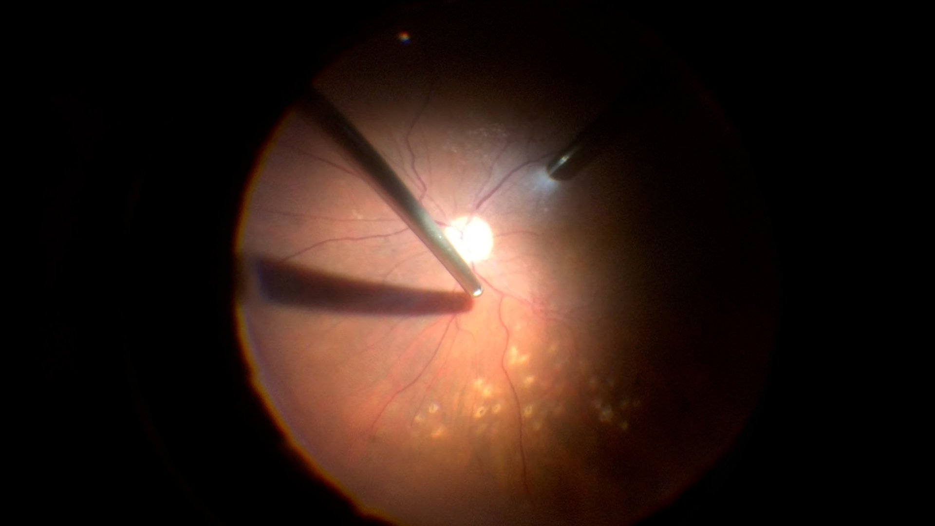 Intraoperative retinal view during vitreoretinal surgery with illuminated optic disc and retinal vessels visible in a dark surgical field.
