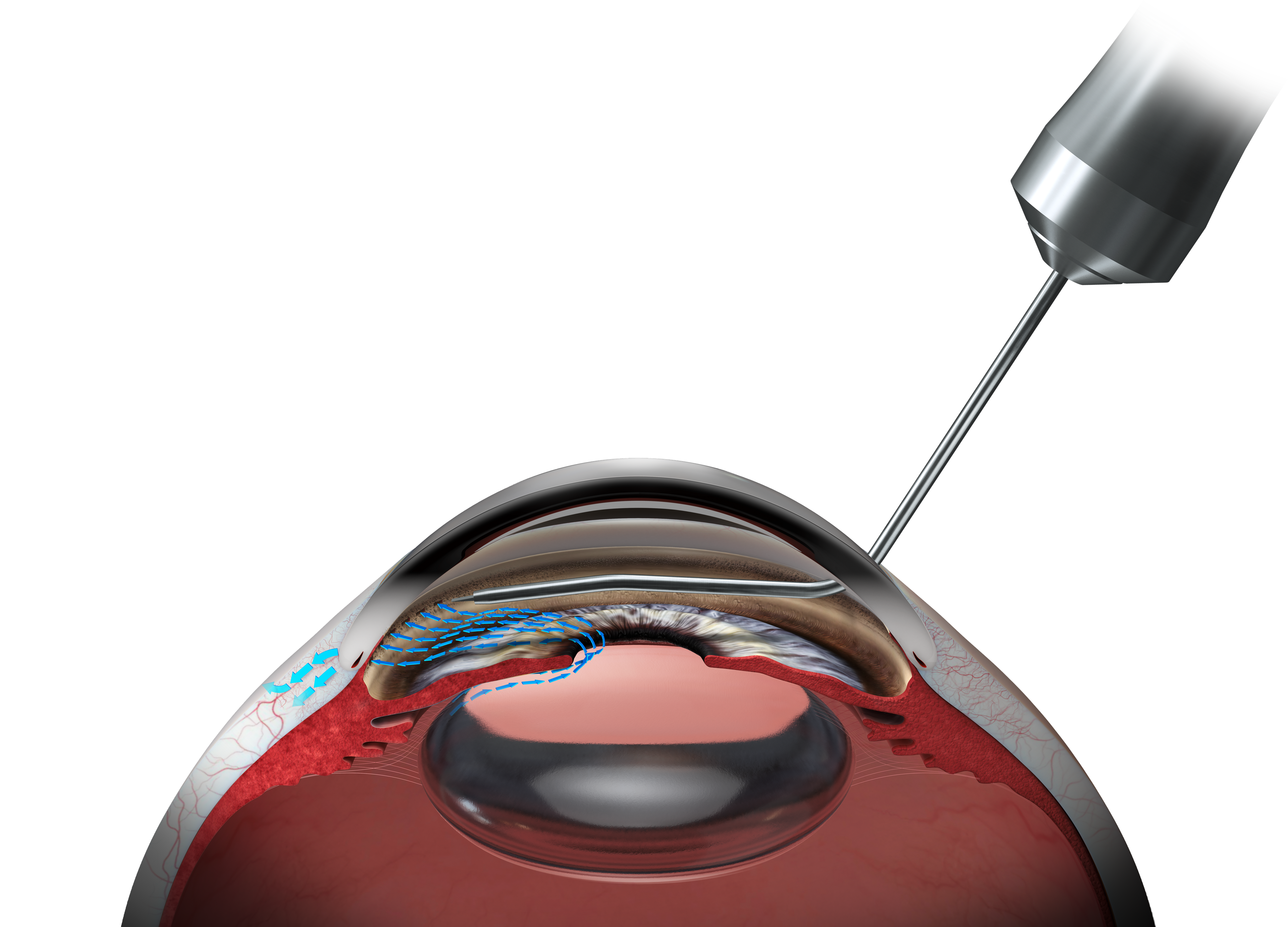 Cross-sectional illustration of the eye showing an HFDS probe creating controlled openings in the trabecular meshwork with arrows indicating enhanced aqueous humour outflow