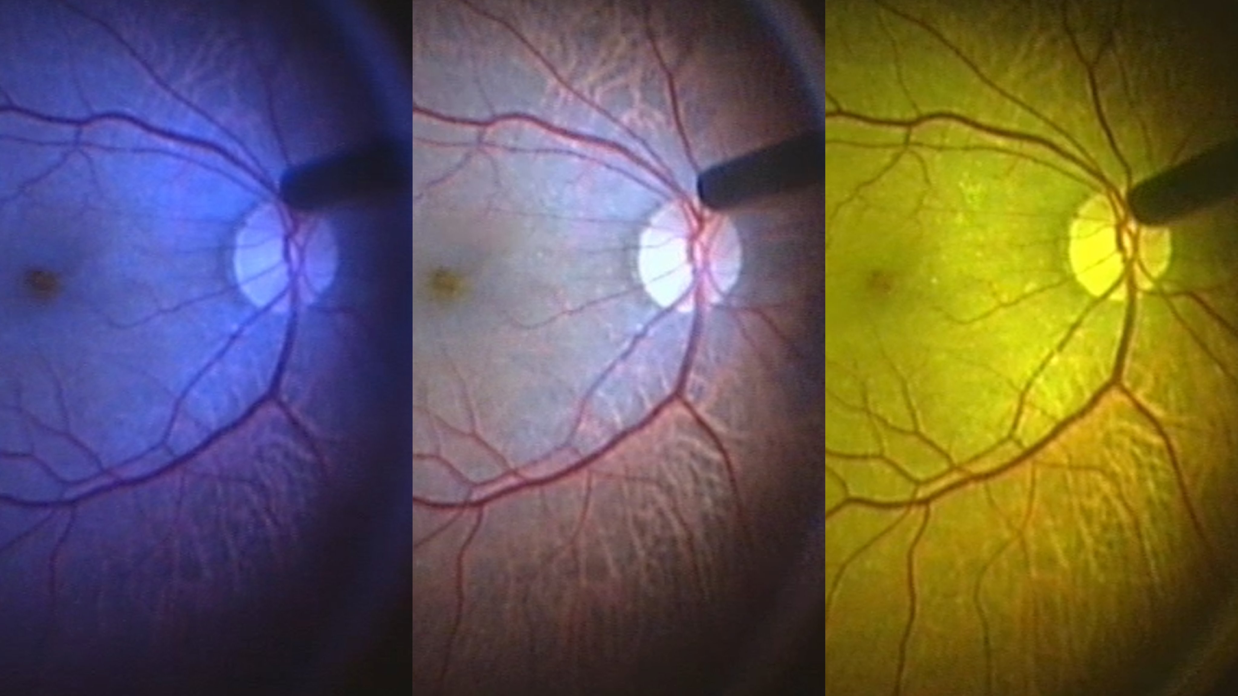Comparison of retinal view under different Power LED Plus light settings, blue, neutral and yellow illumination, highlighting contrast and vessel visibility