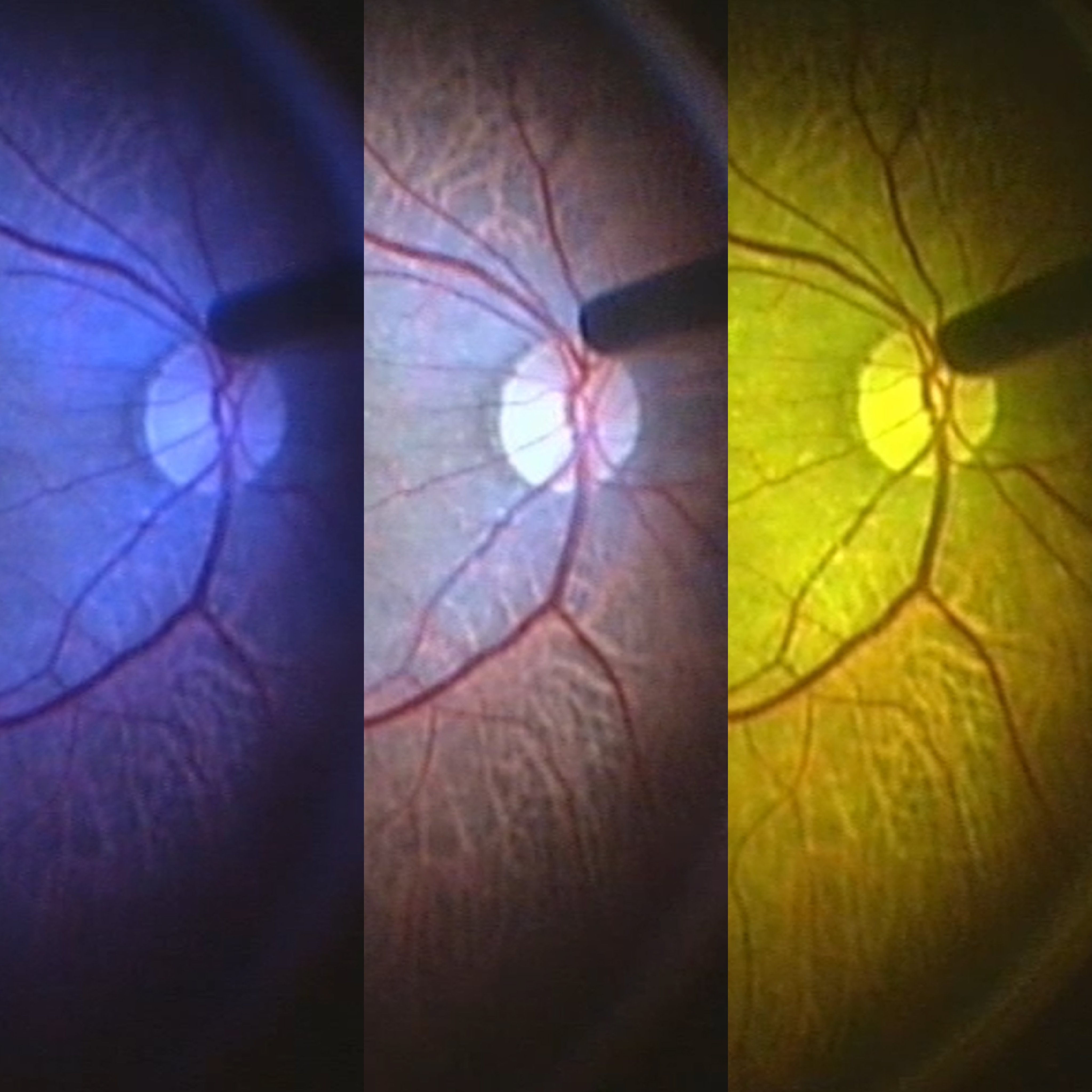 Comparison of retinal view under different Power LED Plus light settings, blue, neutral and yellow illumination, highlighting contrast and vessel visibility
