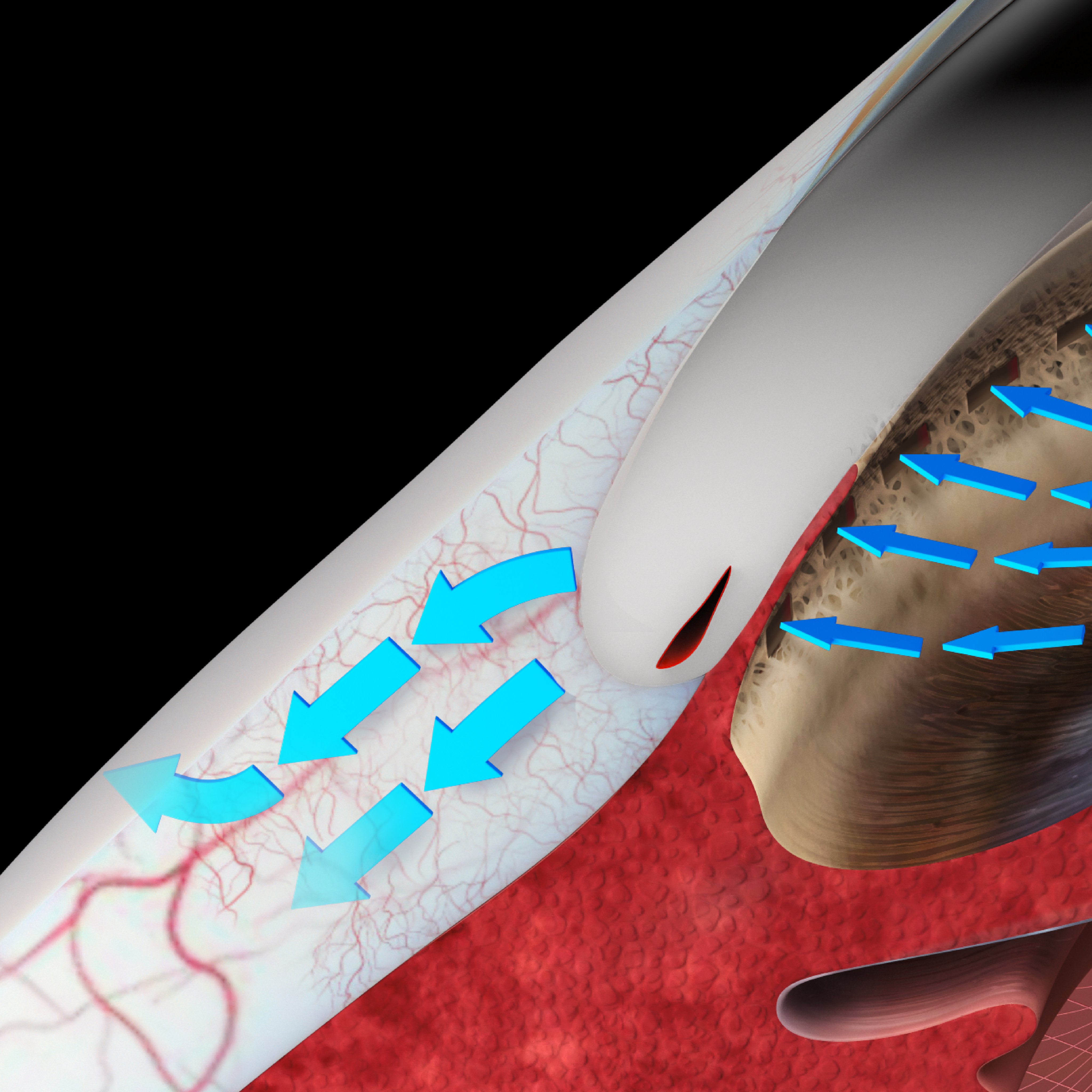 Medical illustration showing improved aqueous outflow through the trabecular meshwork with arrows indicating fluid movement from the anterior chamber into the drainage pathway
