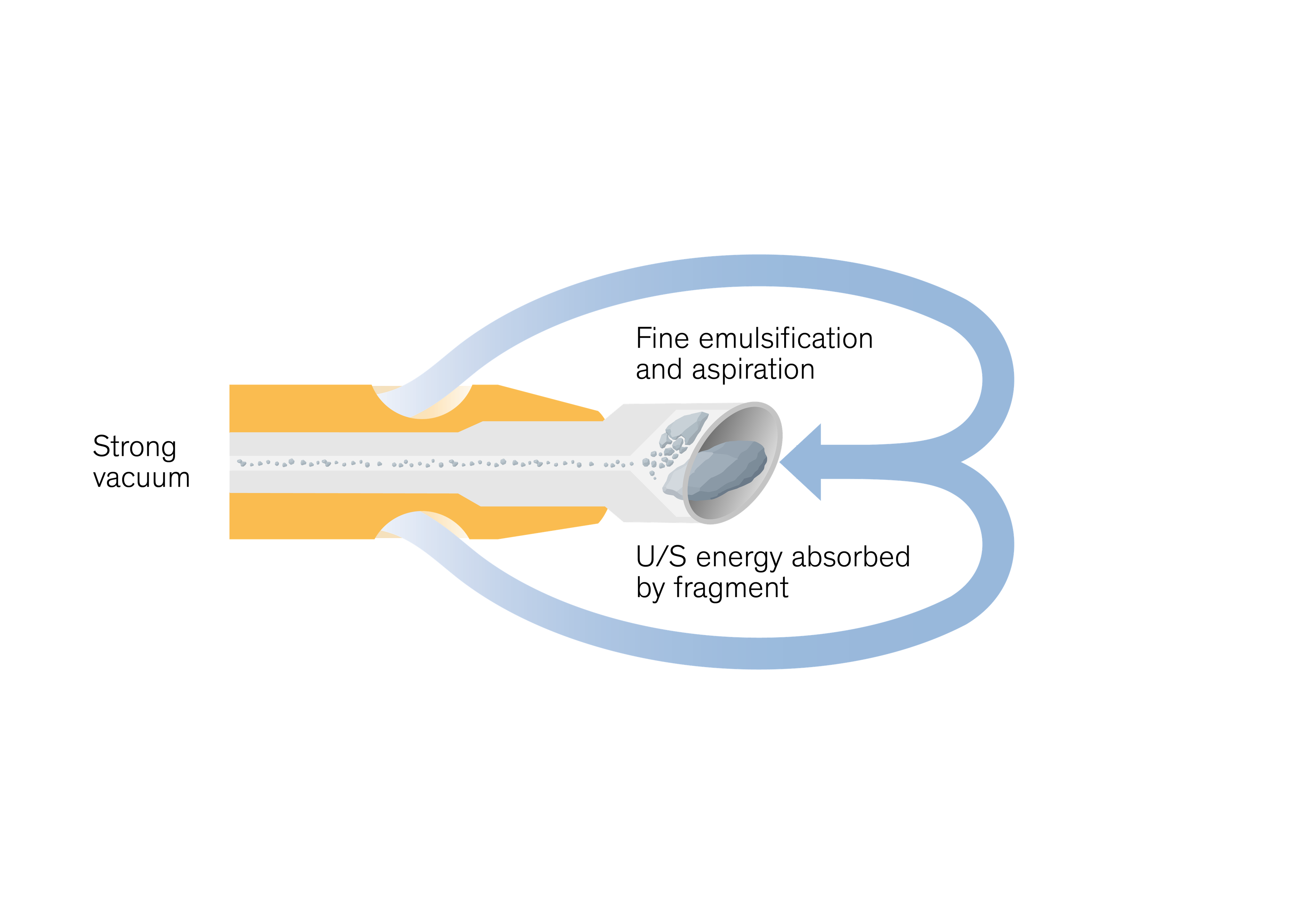 EasyPhaco graphic showing strong vacuum, fine emulsification and aspiration, with ultrasound energy absorbed by the fragment at the phaco tip