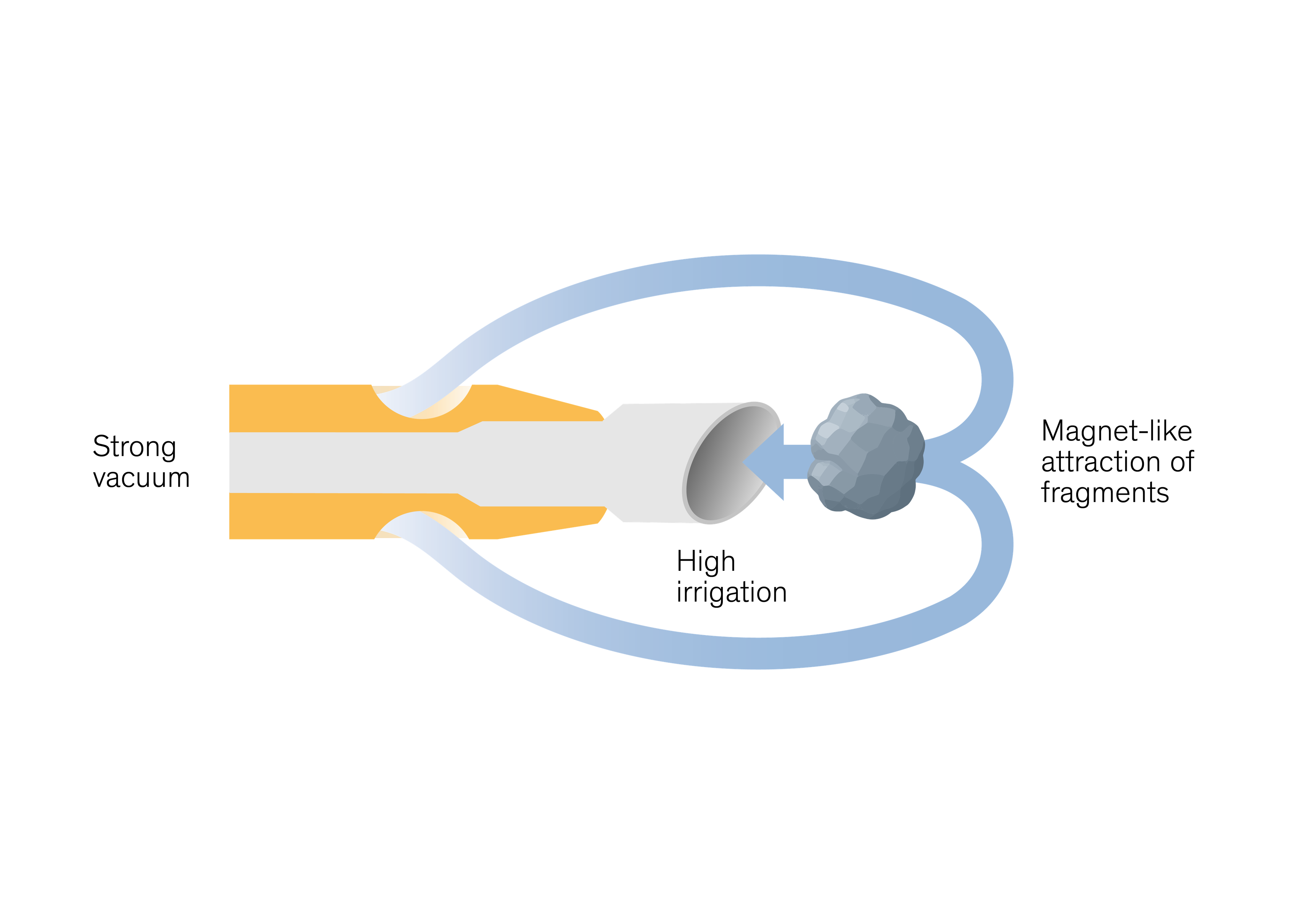EasyPhaco graphic showing strong vacuum and high irrigation creating magnet-like attraction of fragments at the phaco tip