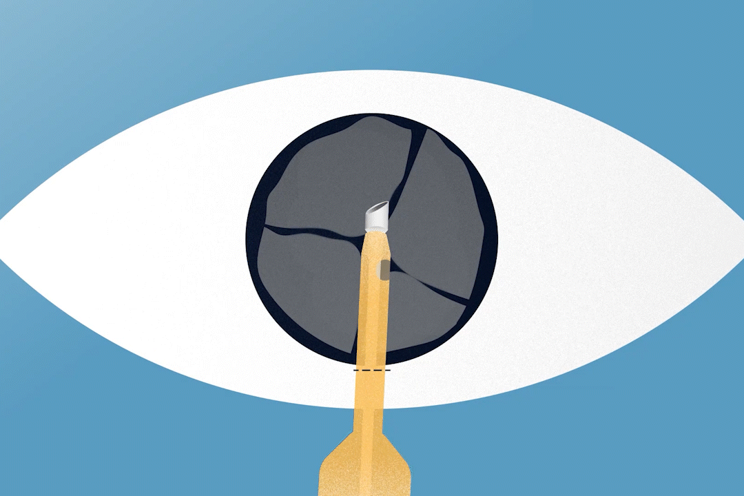 animation of a human eye how easyphaco with change tips works while surgery 