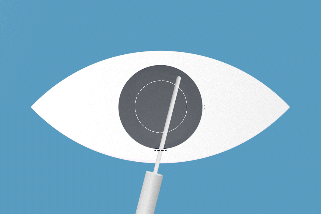 animation of a human eye how easyphaco works while surgery