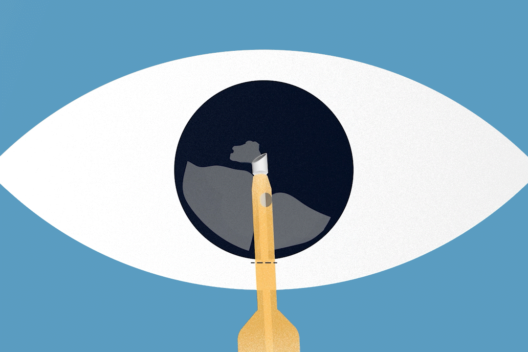 animation of a human eye how easyphaco works while surgery