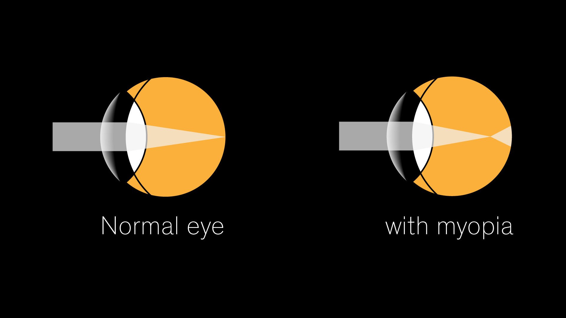 Illustration comparing light focus in a normal eye and an eye with myopia