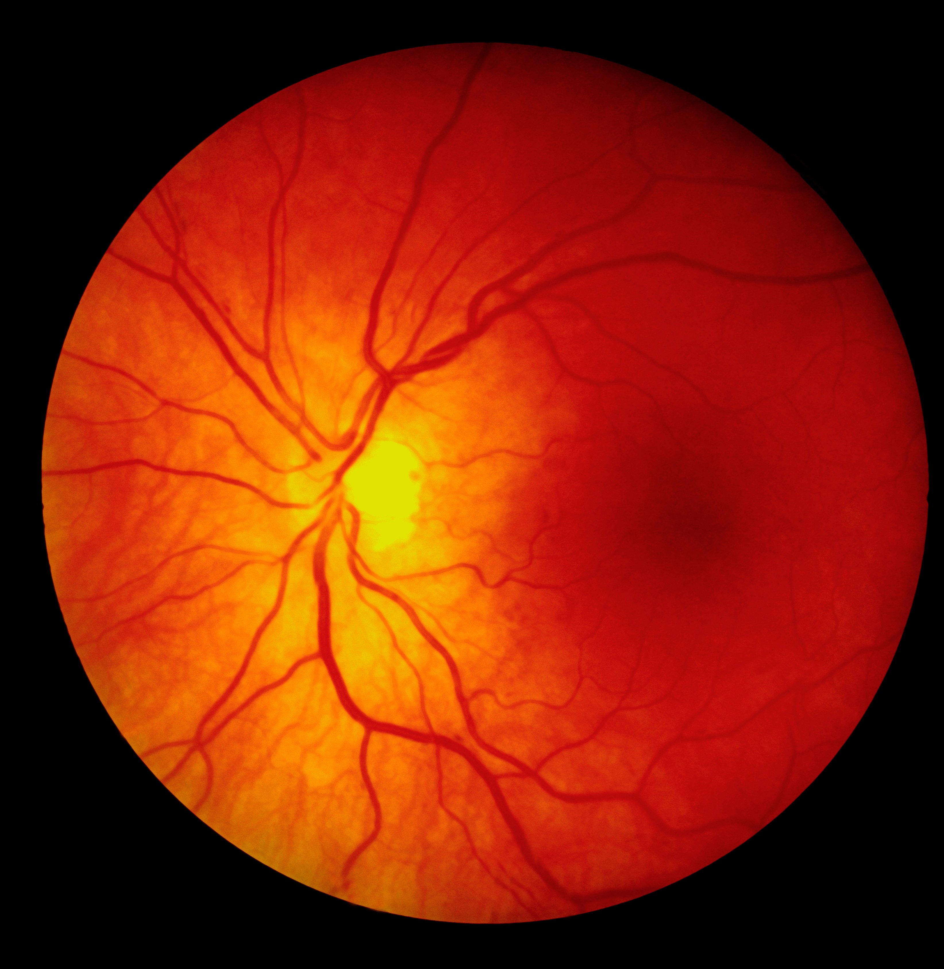 Fundus photography involves photographing the rear of an eye (also known as the fundus). The main structures that can be visualized on a fundus photo are the central and peripheral retina, optic disc and macula.