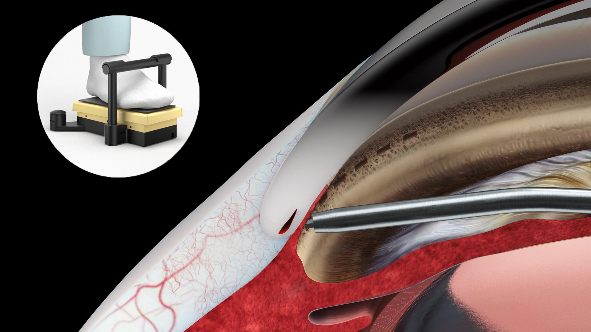 graphic of the procedure with hfds and the foot pedal