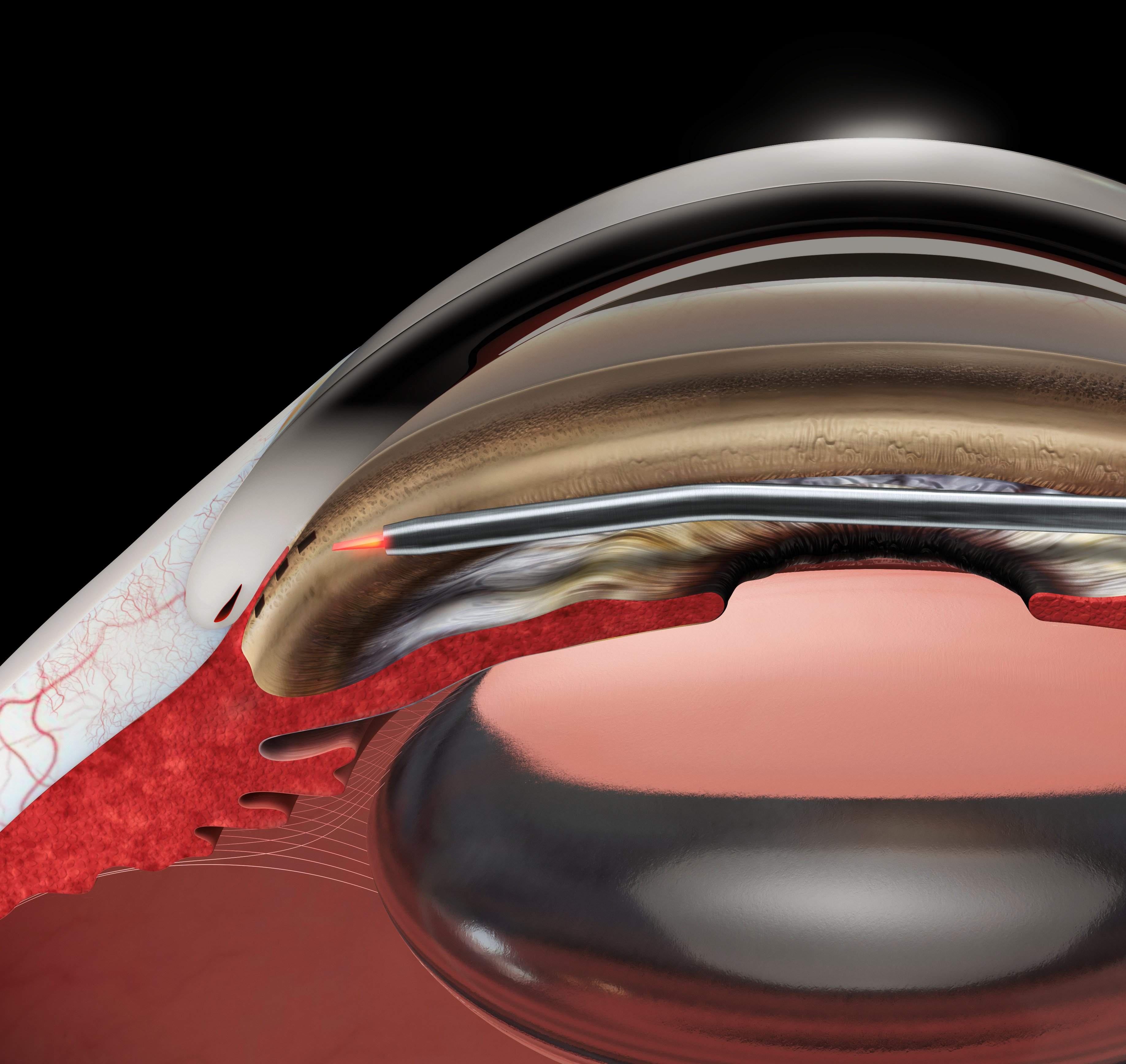 Cross-sectional medical illustration of the eye showing HFDS creating outflow pockets in the trabecular meshwork with a probe inserted into Schlemm’s canal
