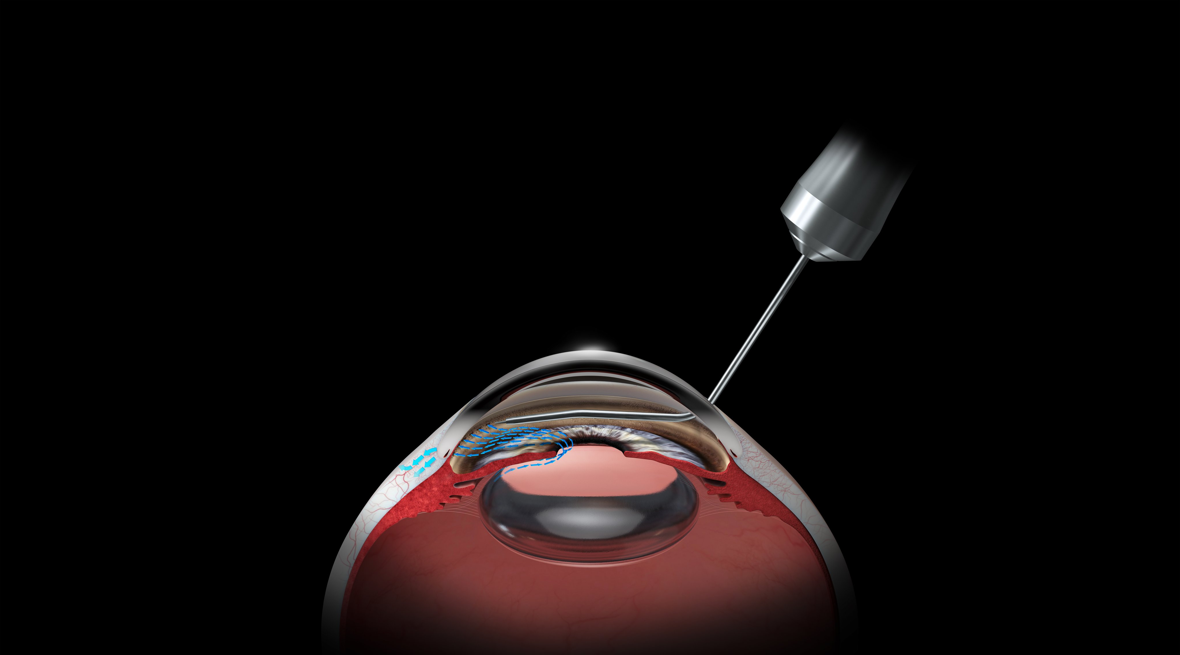 Cross sectional illustration of eye during HFDS procedure, showing instrument access and fluid flow along Schlemm’s canal with targeted outflow enhancement