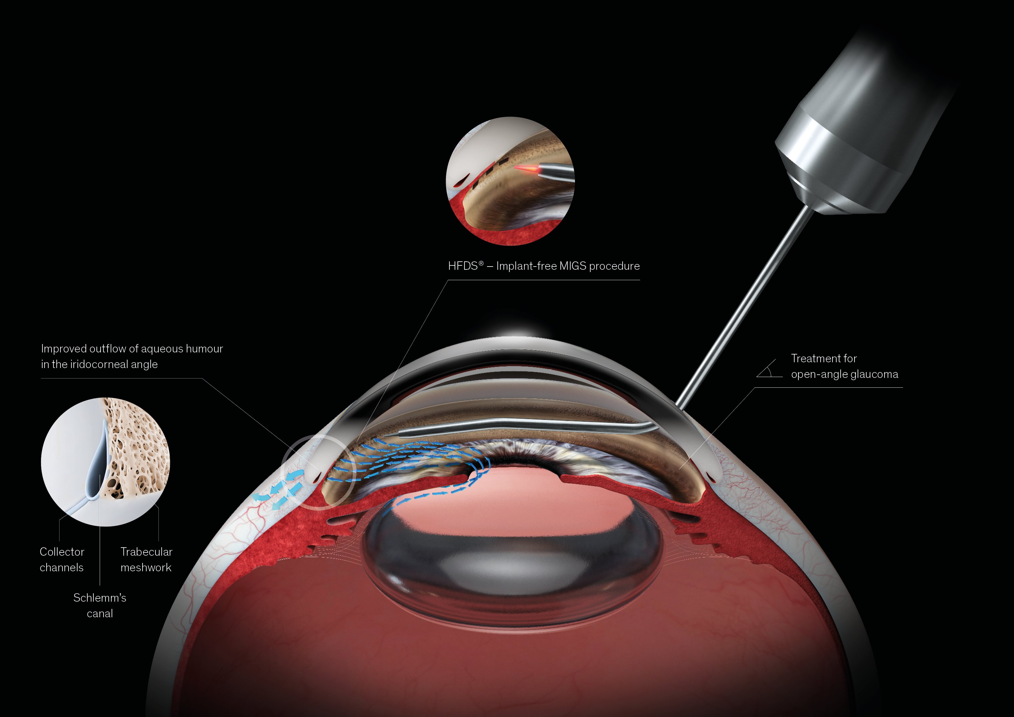 Illustration of the HFDS implant-free MIGS procedure for open-angle glaucoma, showing aqueous humour outflow through Schlemm’s canal, collector channels and the trabecular meshwork