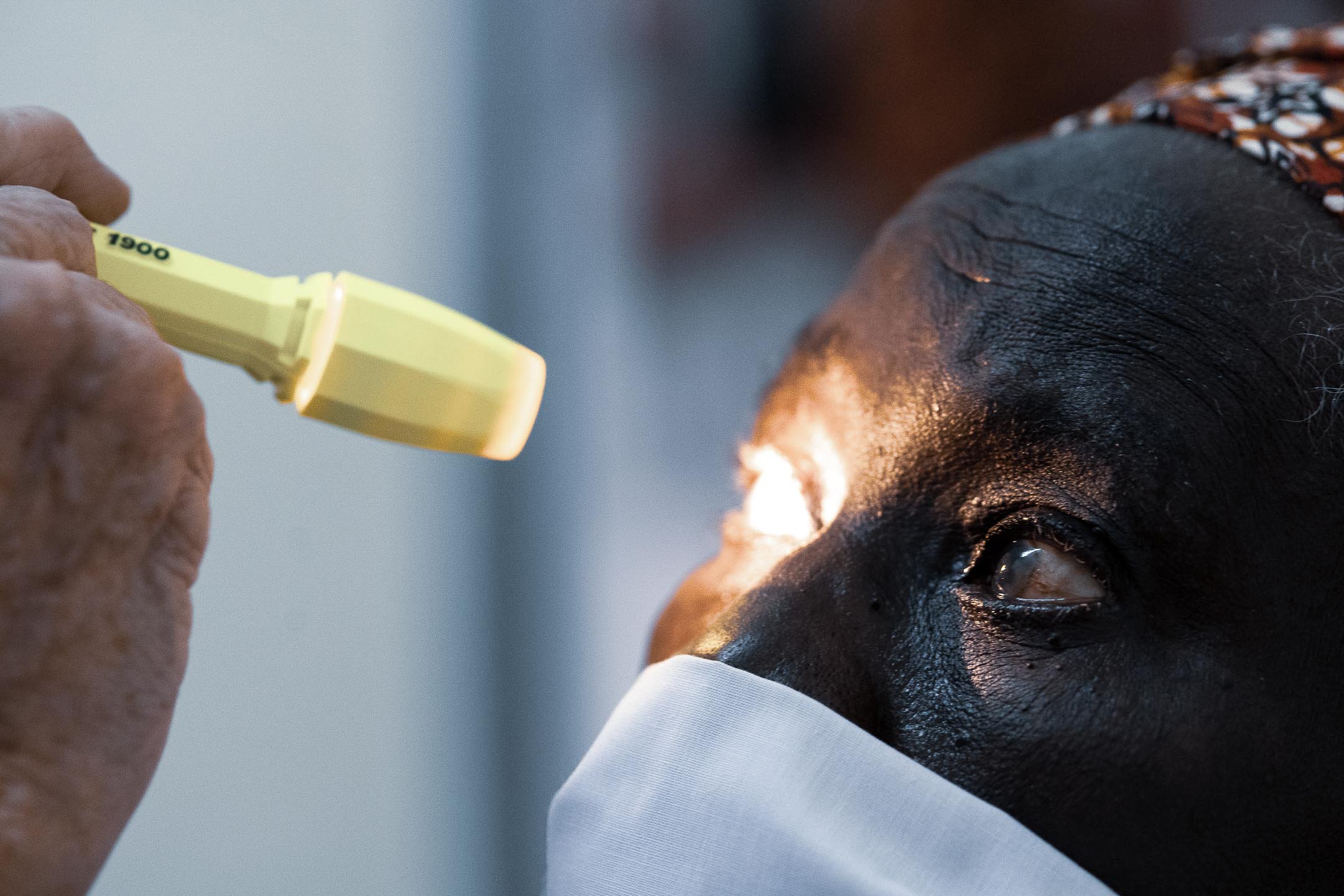 Close up of a patient undergoing an eye examination with a handheld ophthalmic light during a charitable medical outreach mission.