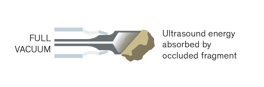 EasyPhaco graphic showing full vacuum with ultrasound energy absorbed by the occluded lens fragment at the tip